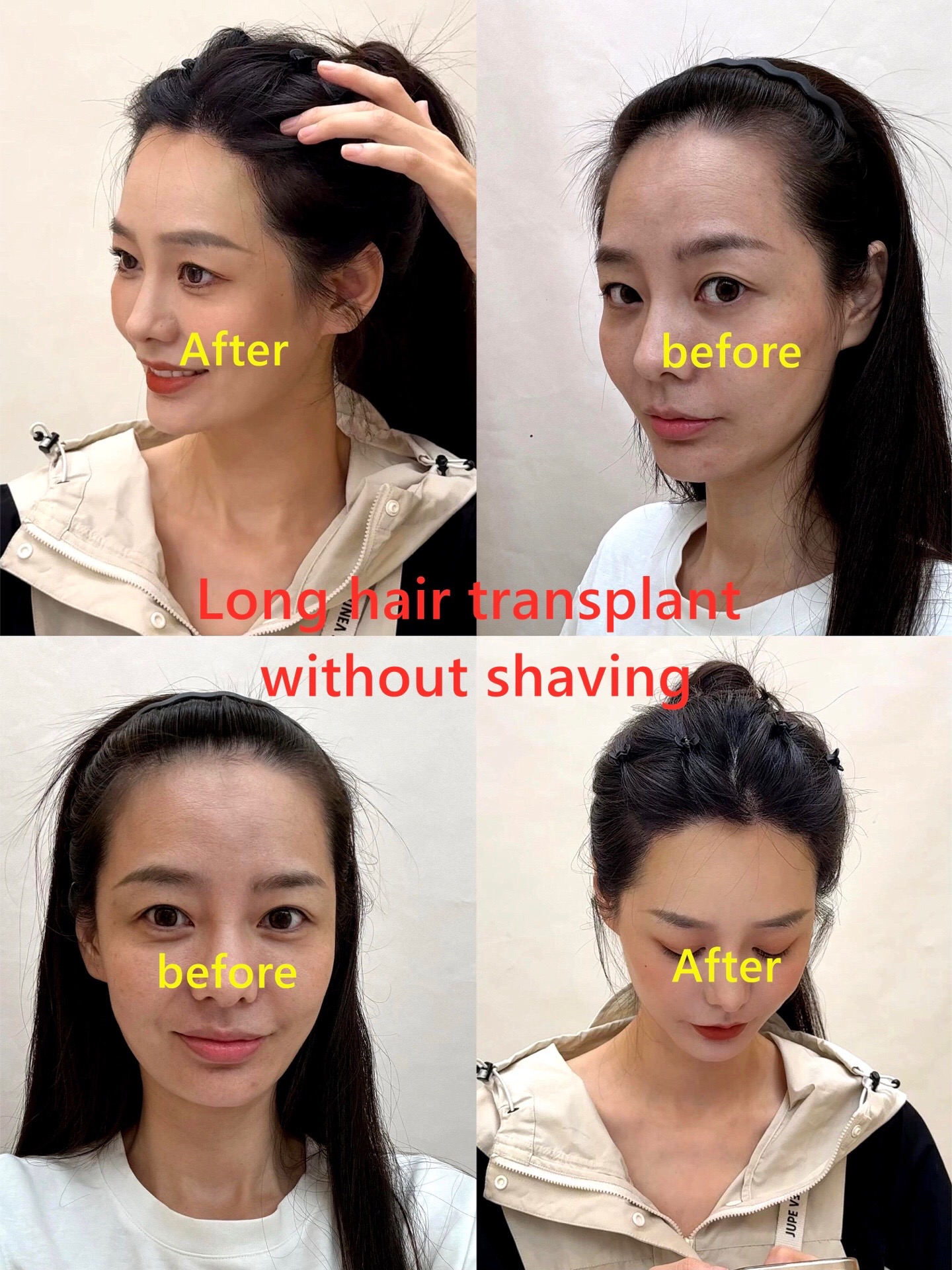 @HAIR TRANSPLANT WANG🇨🇳