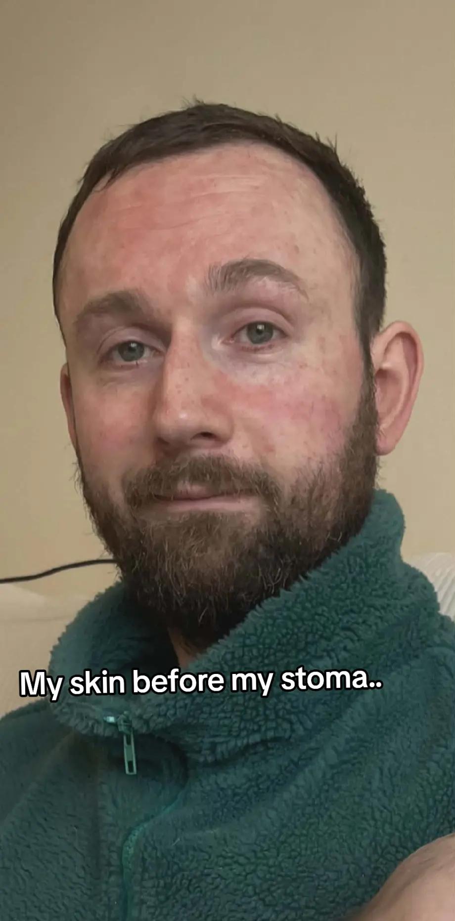@Running Stoma