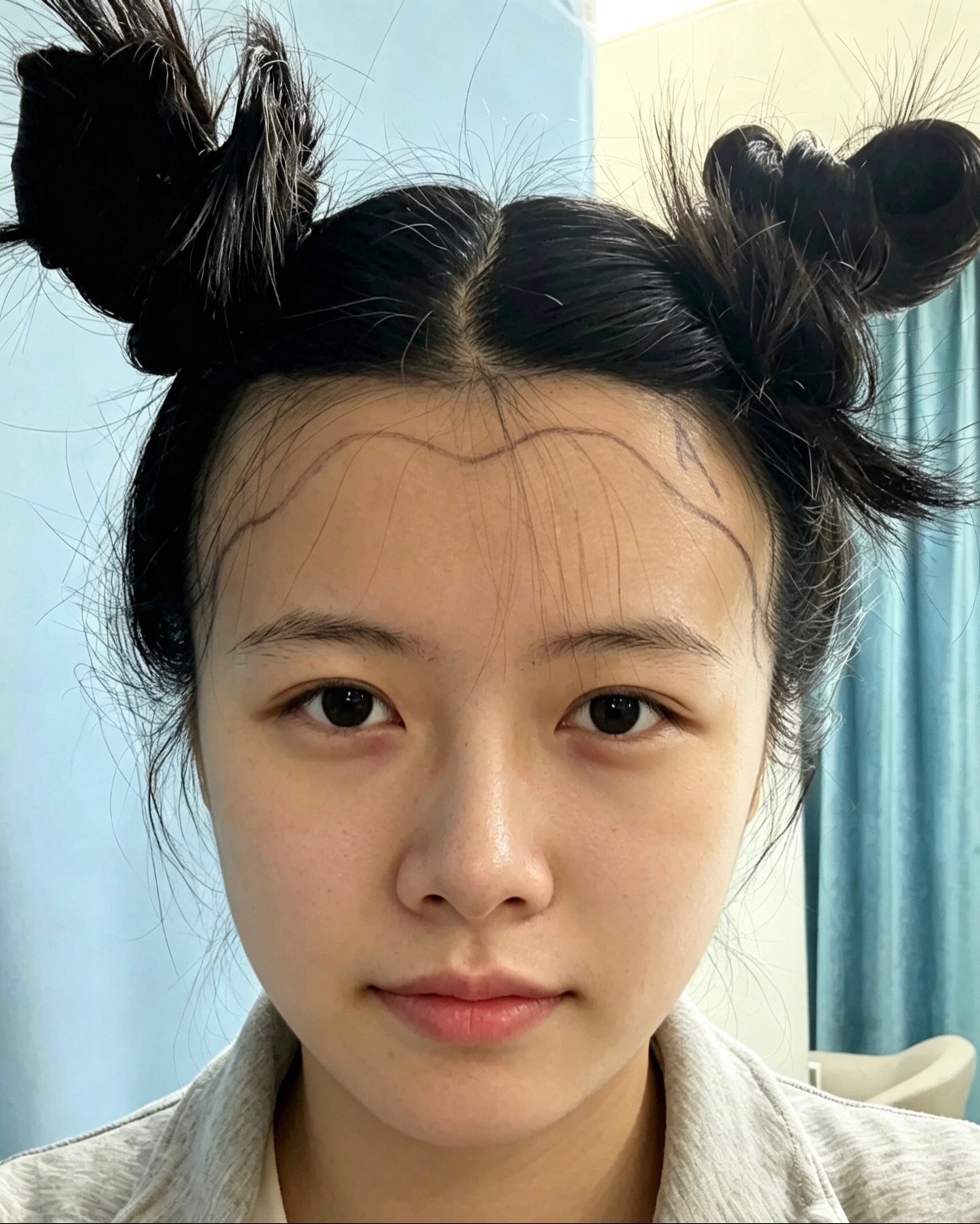 @HAIR TRANSPLANT WANG🇨🇳