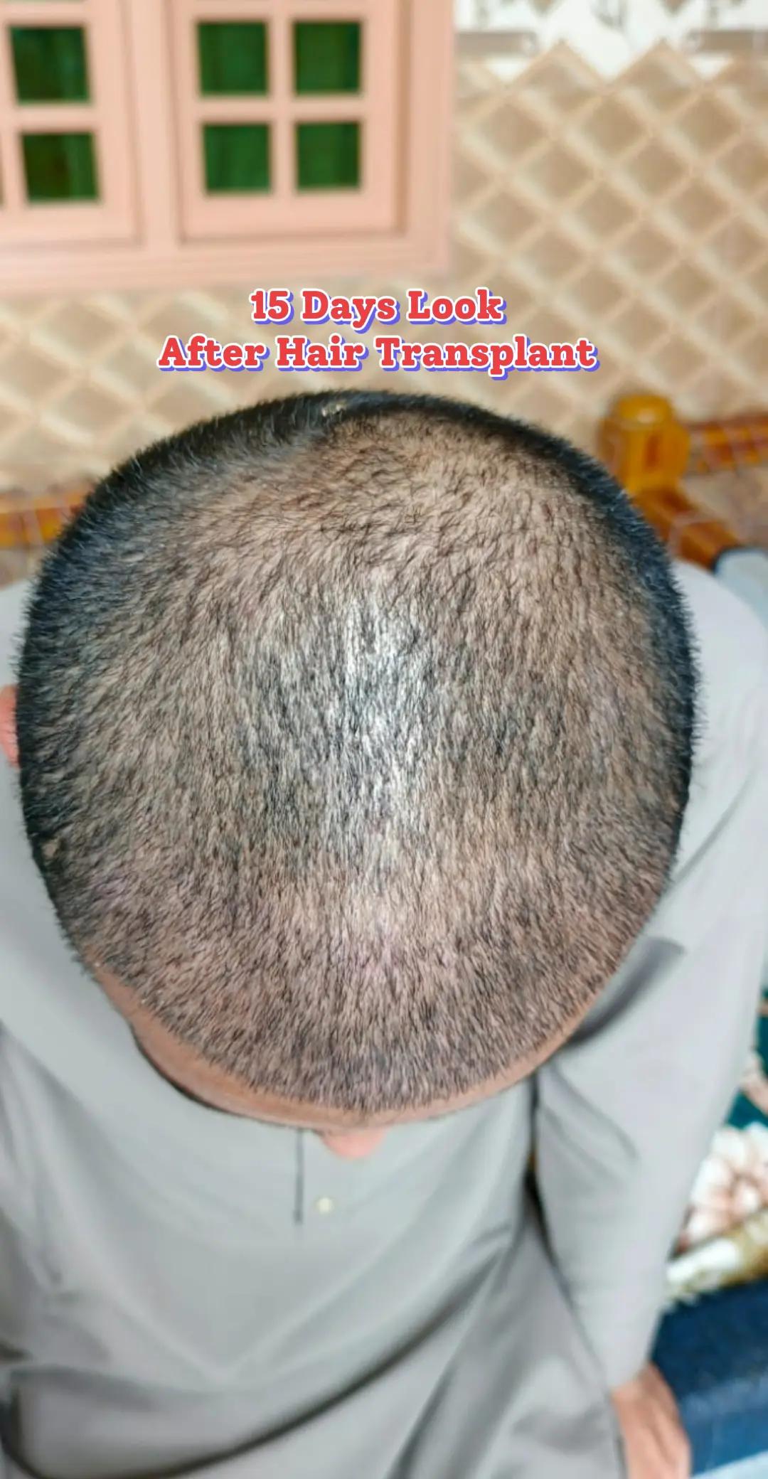 @Dr Asad shalman HairTransplant