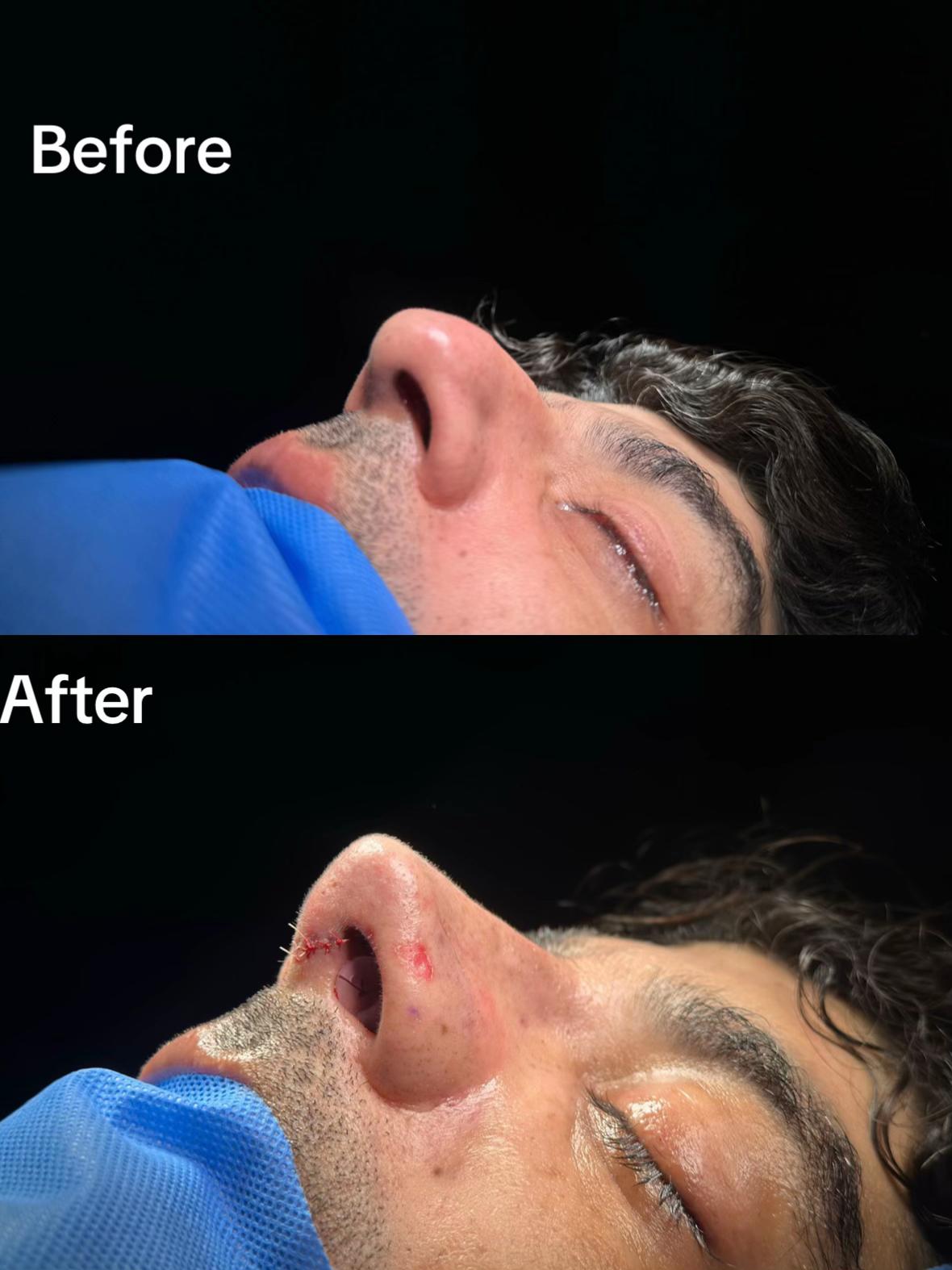 @Rhinoplastyhub clinic222