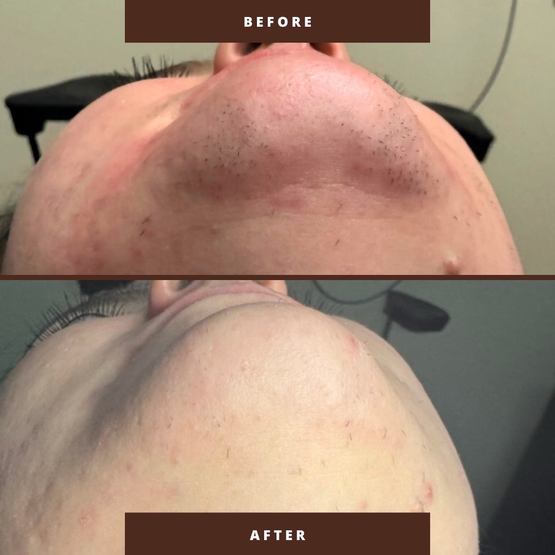 @Neurospice Beauty Electrolysis
