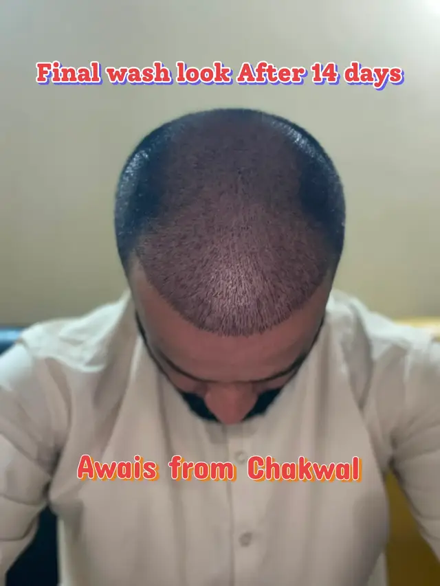 @Dr Asad shalman HairTransplant