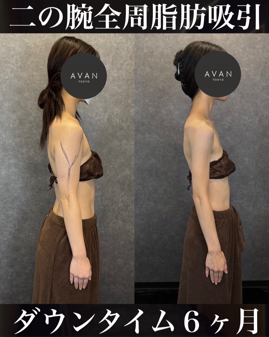 @森脇進/二の腕脂肪吸引・豊胸/AVAN TOKYO