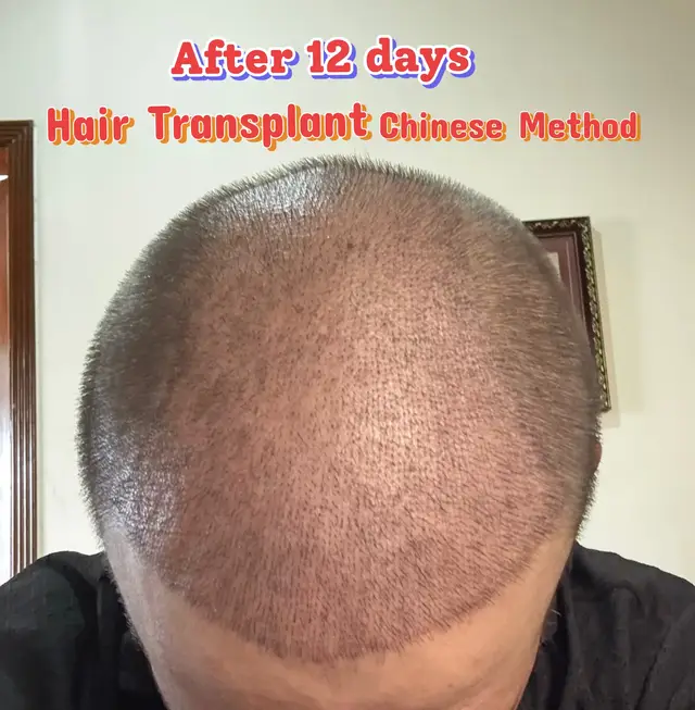 @Dr Asad shalman HairTransplant