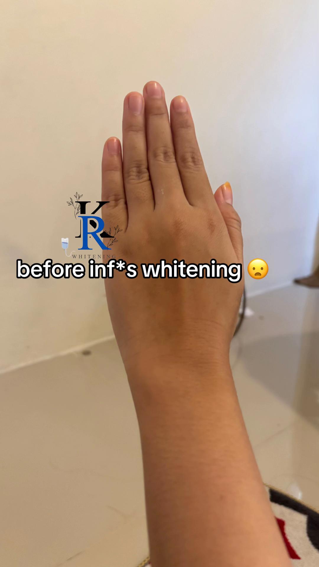 @RK WHITENING