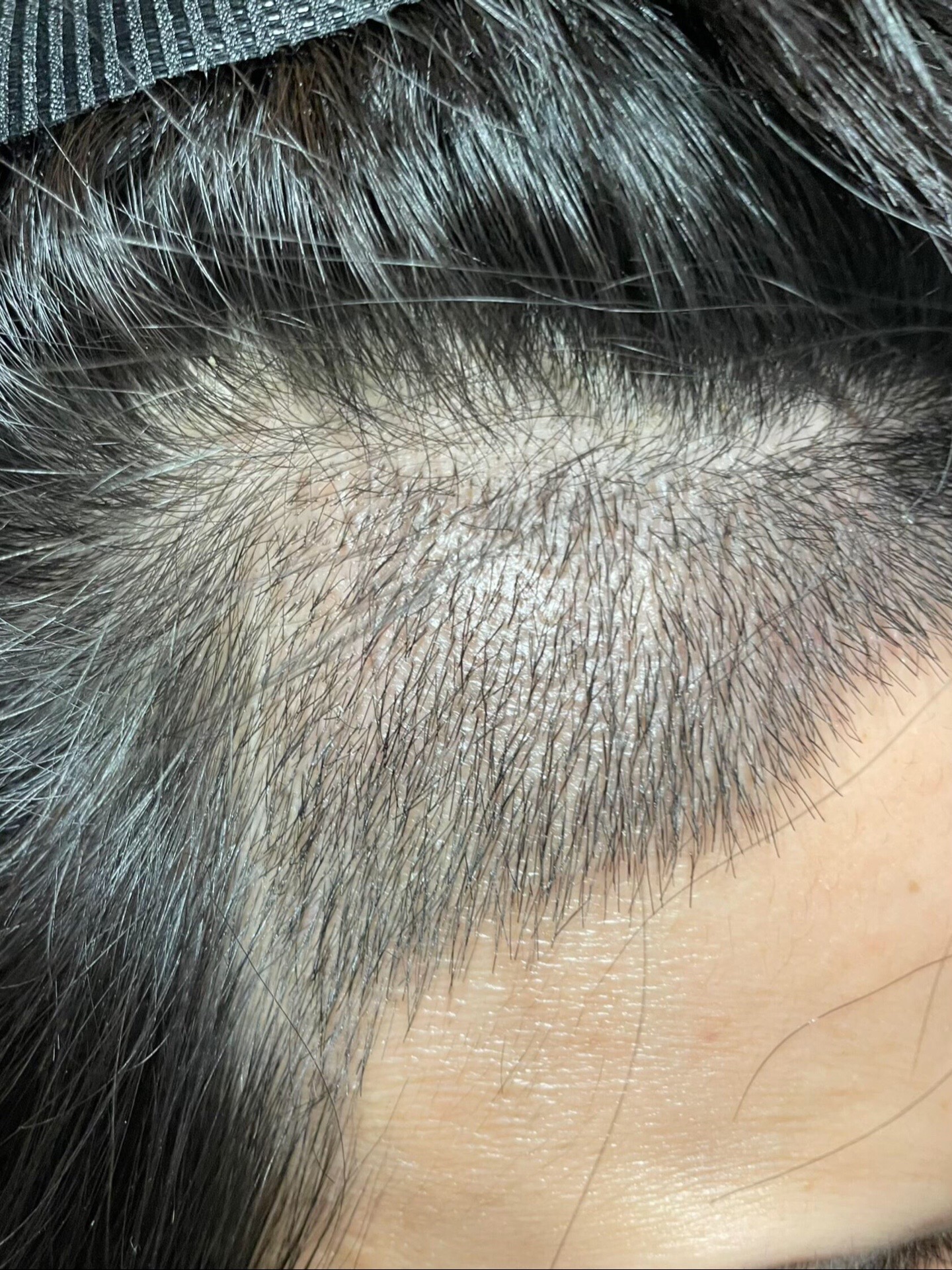 @HAIR TRANSPLANT WANG🇨🇳
