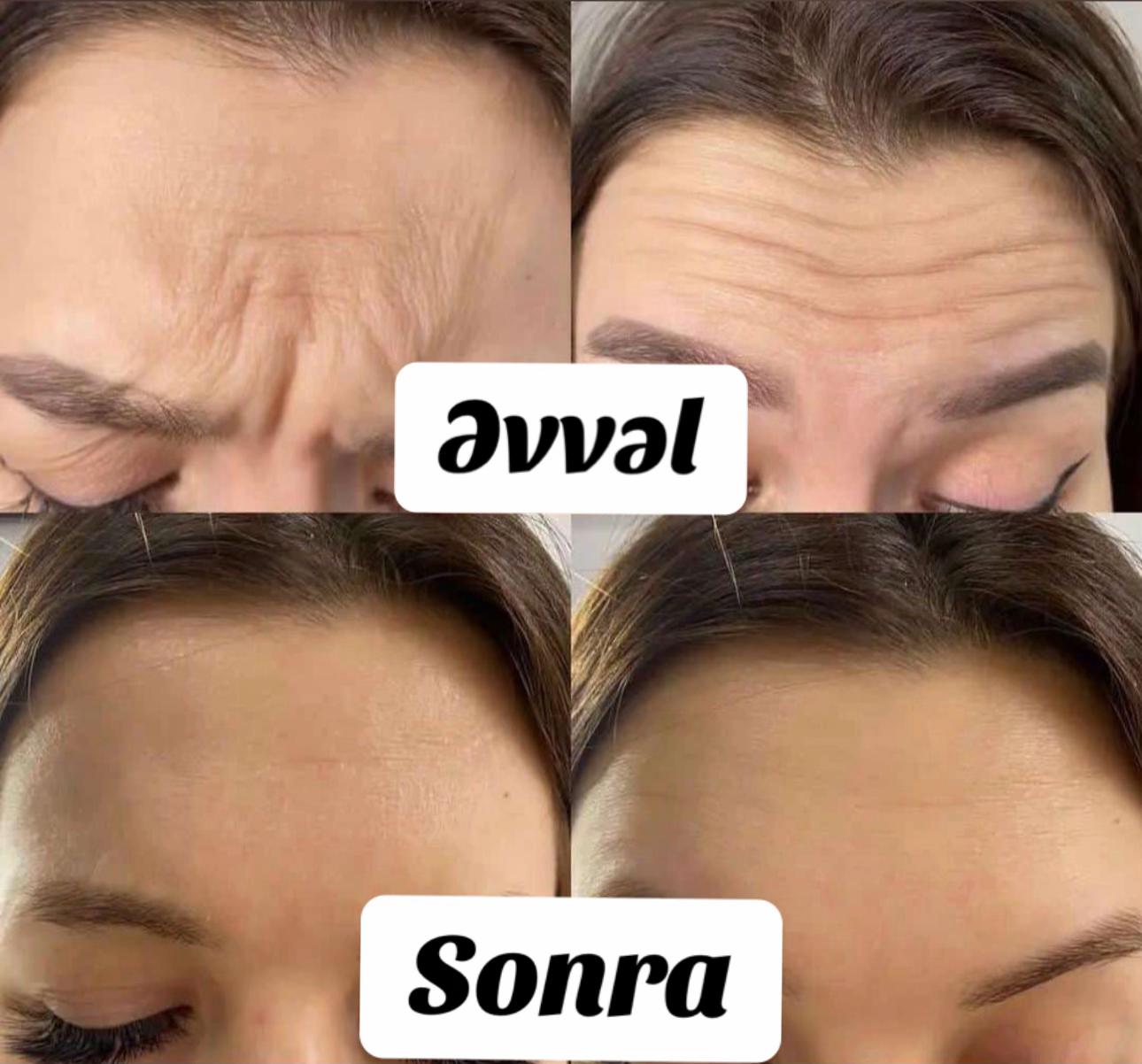 @Xankəndi.Şuşa.💉Kosmetoloq💉