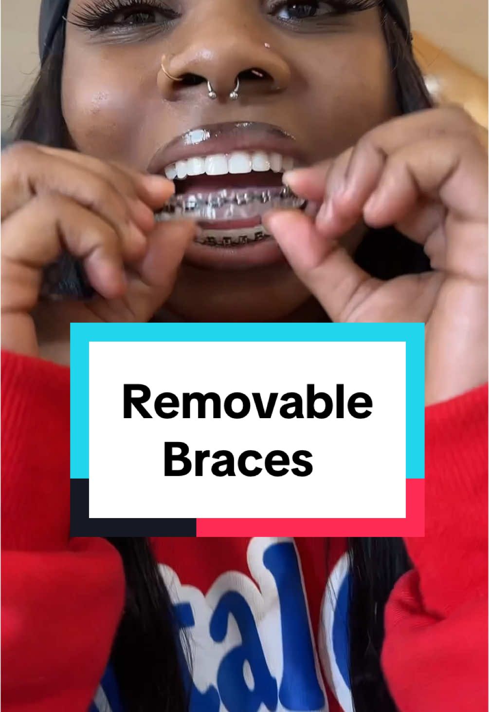 @Braces Survival Guide