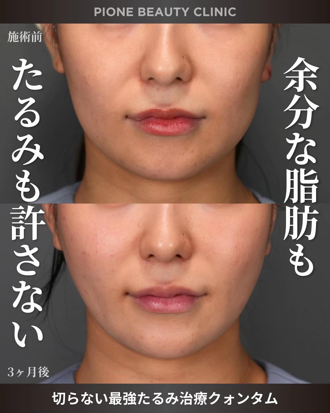 @金澤紀臣【小顔/若返り/脂肪吸引】