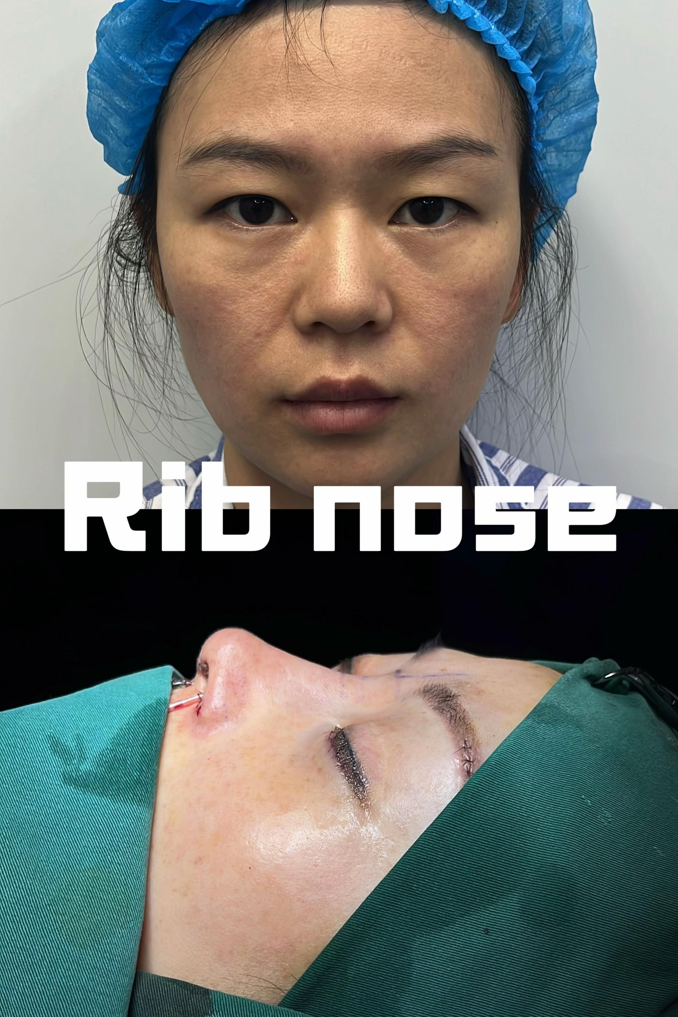 @Nose augmentation