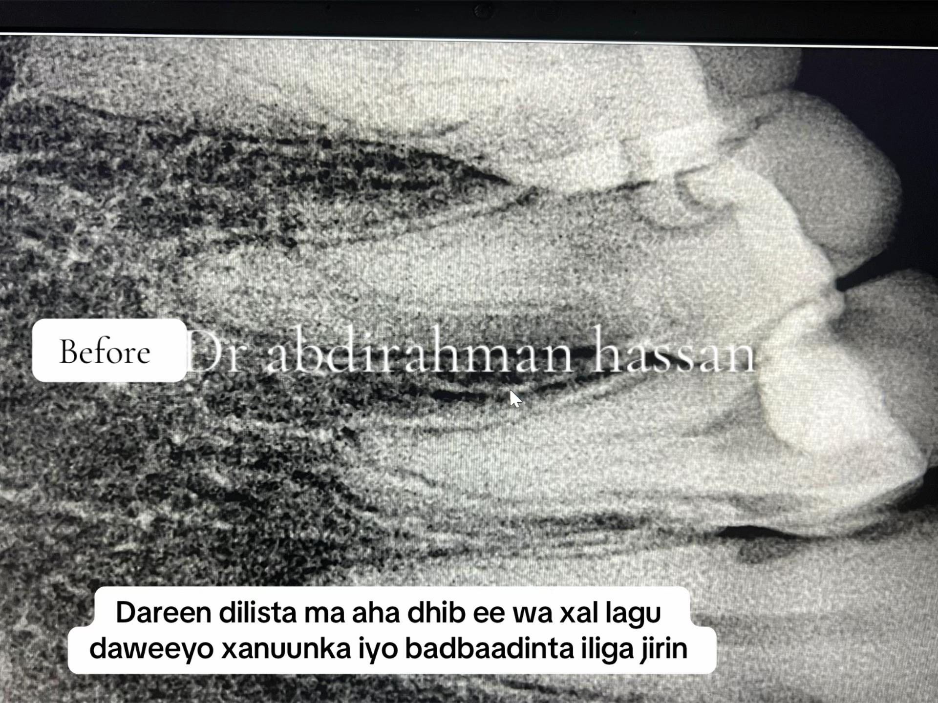 @Dr Abdirahman hassan laari