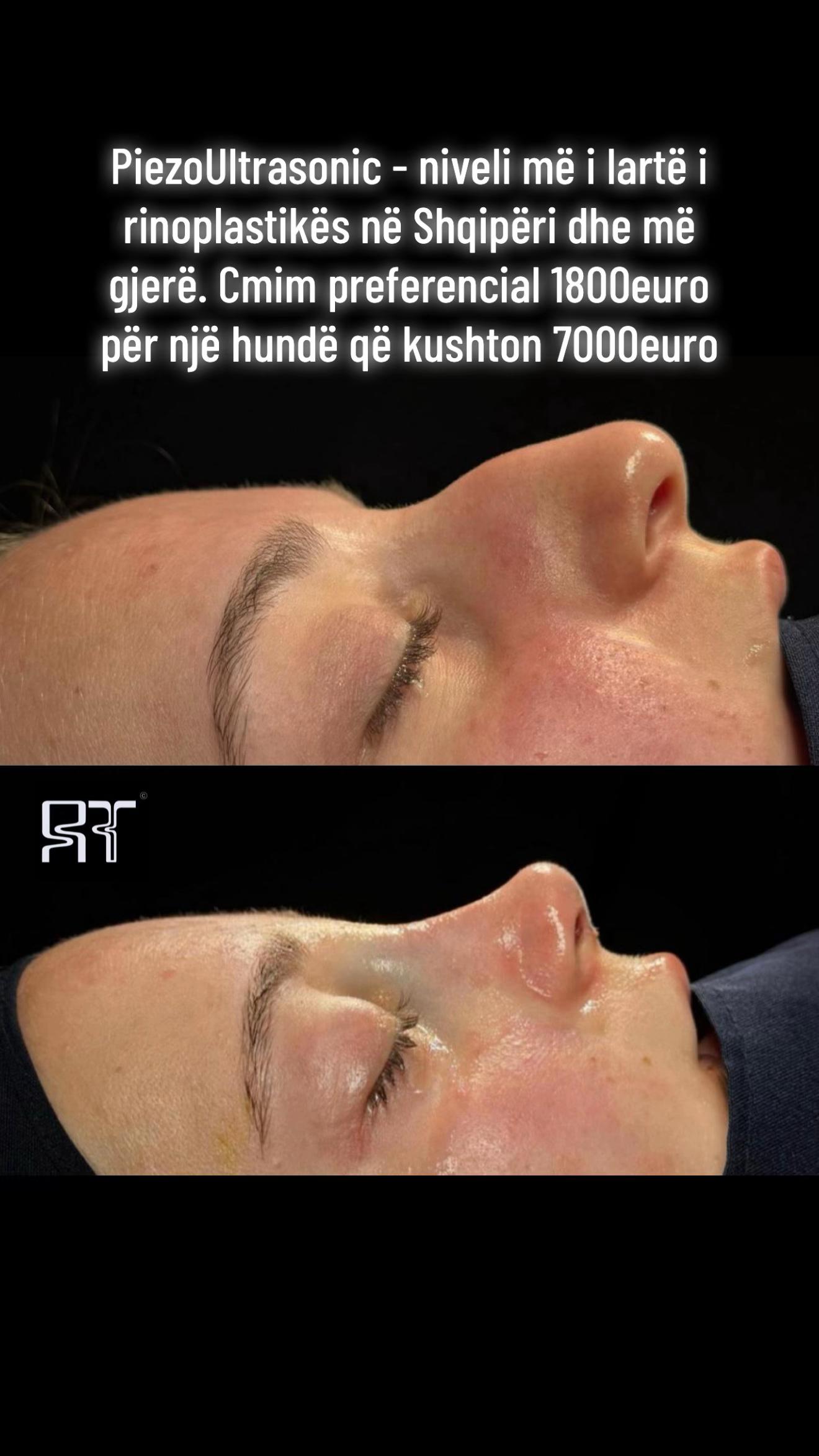 @rinoplasticatirana