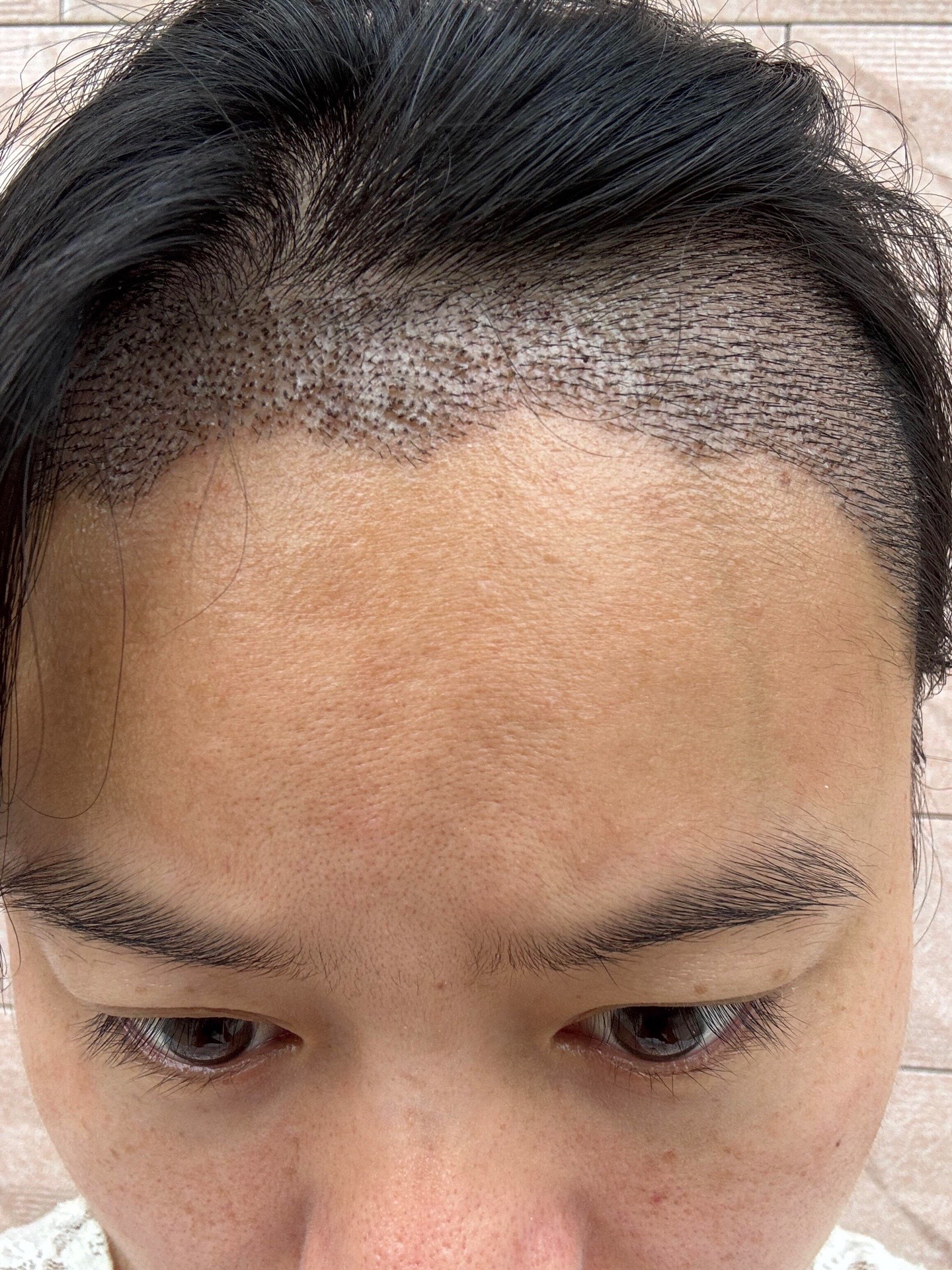 @HAIR TRANSPLANT WANG🇨🇳