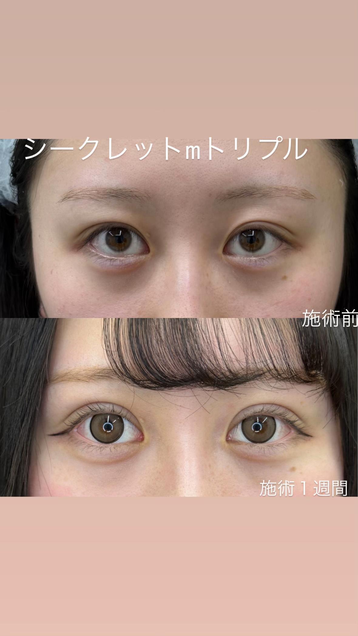 @二重整形埋没法/広島美容外科メイプルクリニック院長 吉本如良