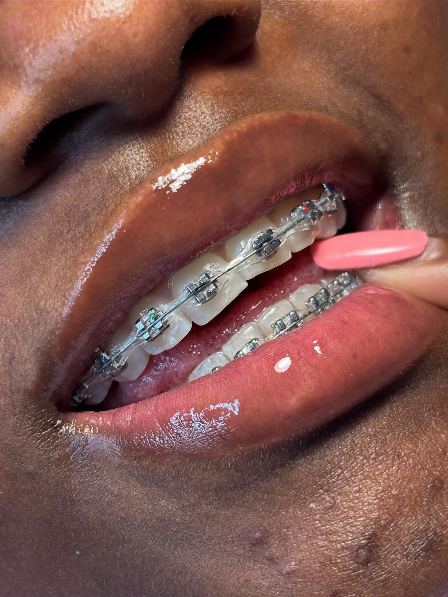 @MG BRACES