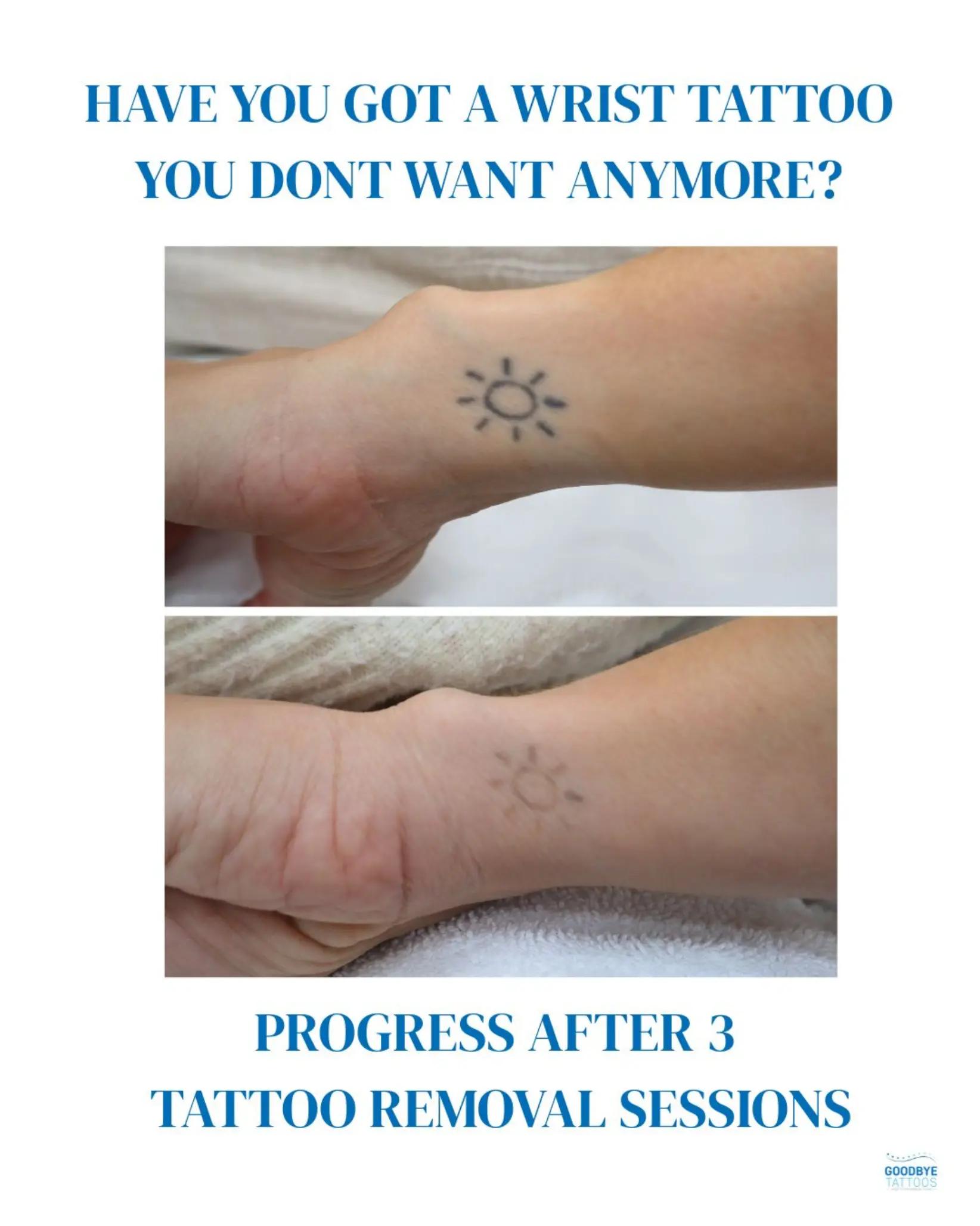 @Jamie T| Tattoo Removal Expert