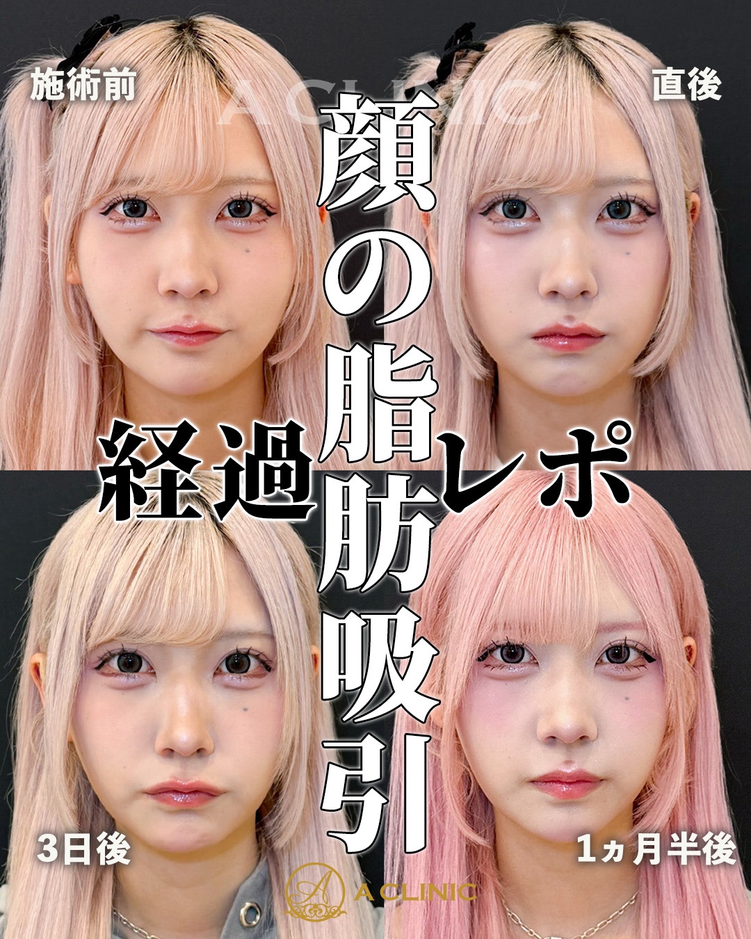@ACLINIC池袋院【小顔/中顔面短縮】