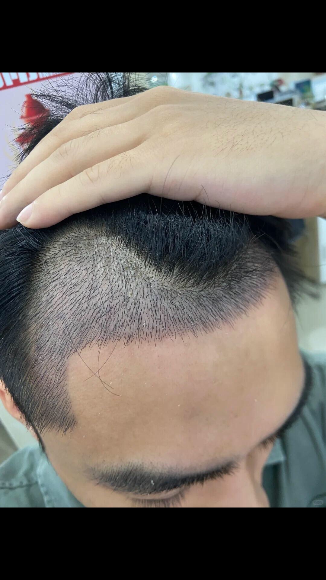 @HAIR TRANSPLANT WANG🇨🇳