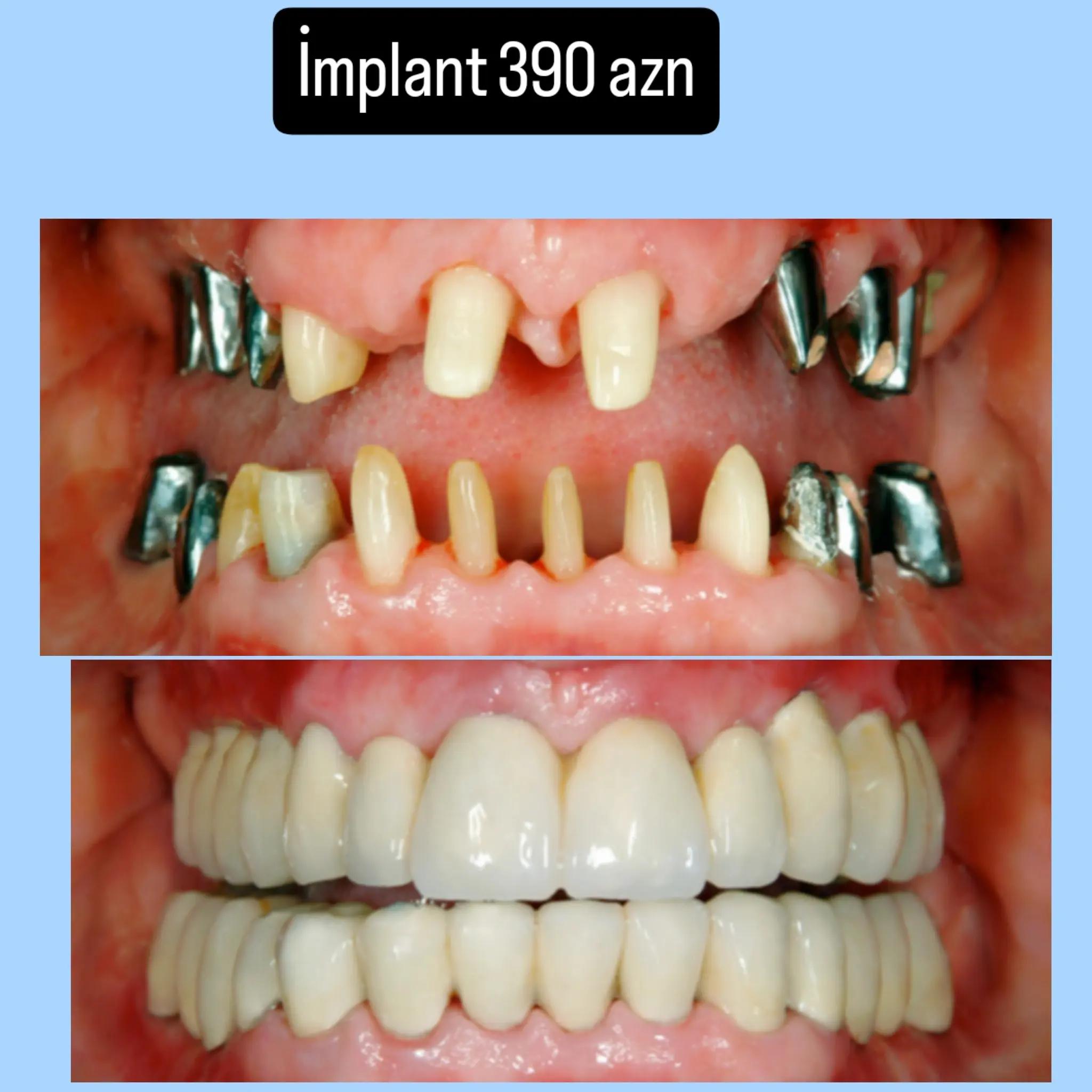 @implant.32