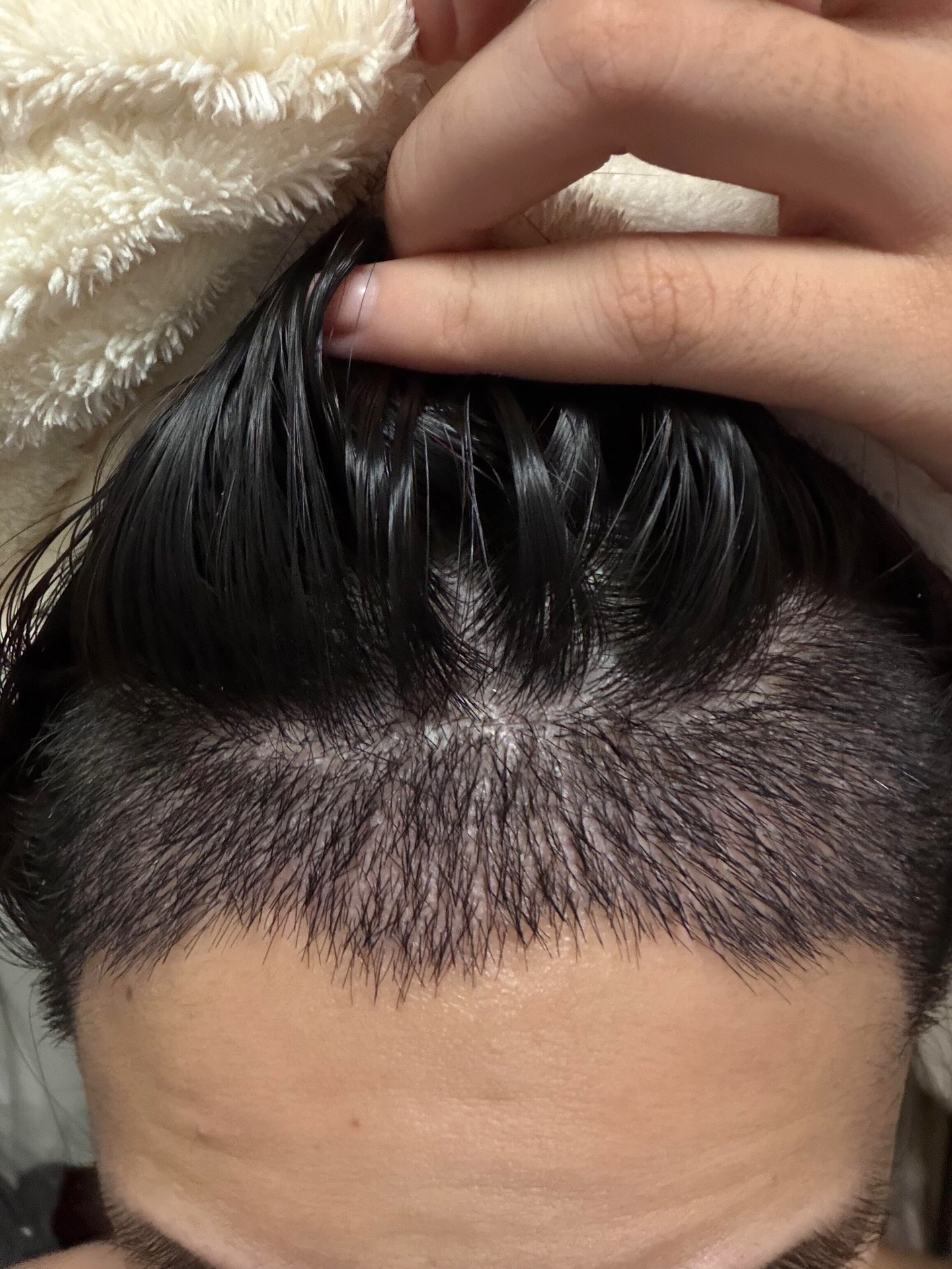 @HAIR TRANSPLANT WANG🇨🇳