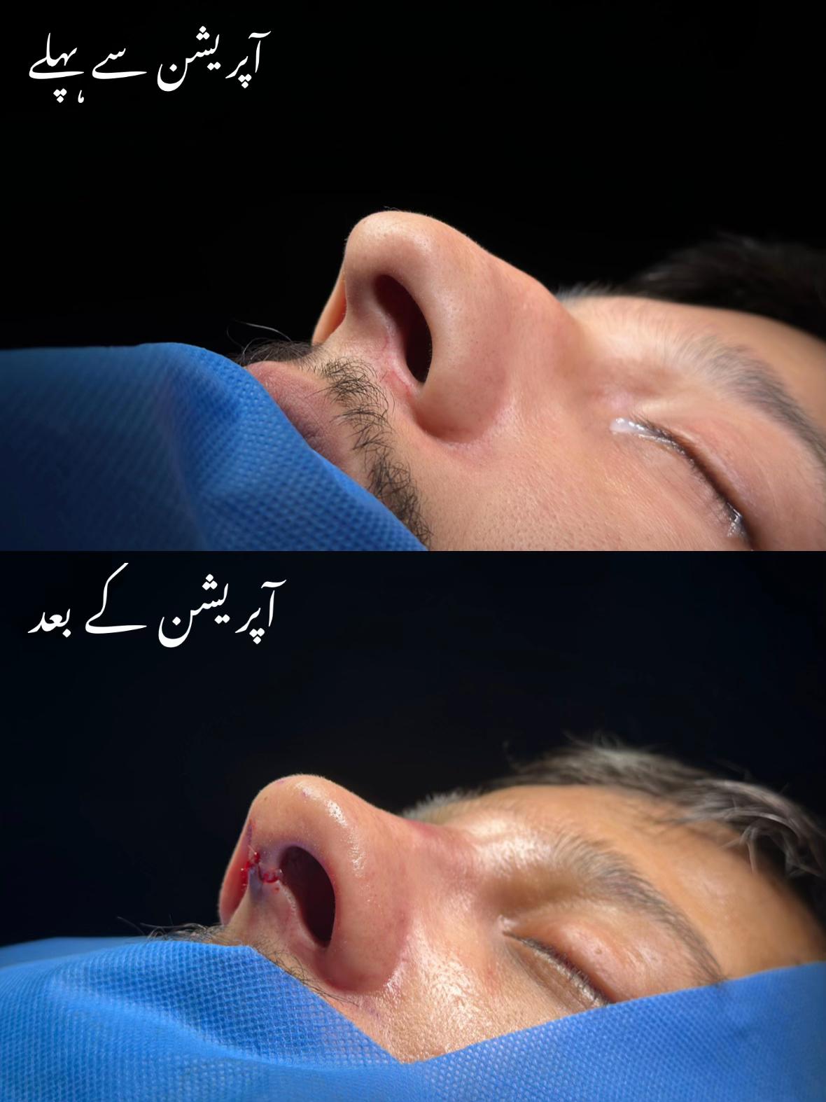 @Rhinoplastyhub clinic222