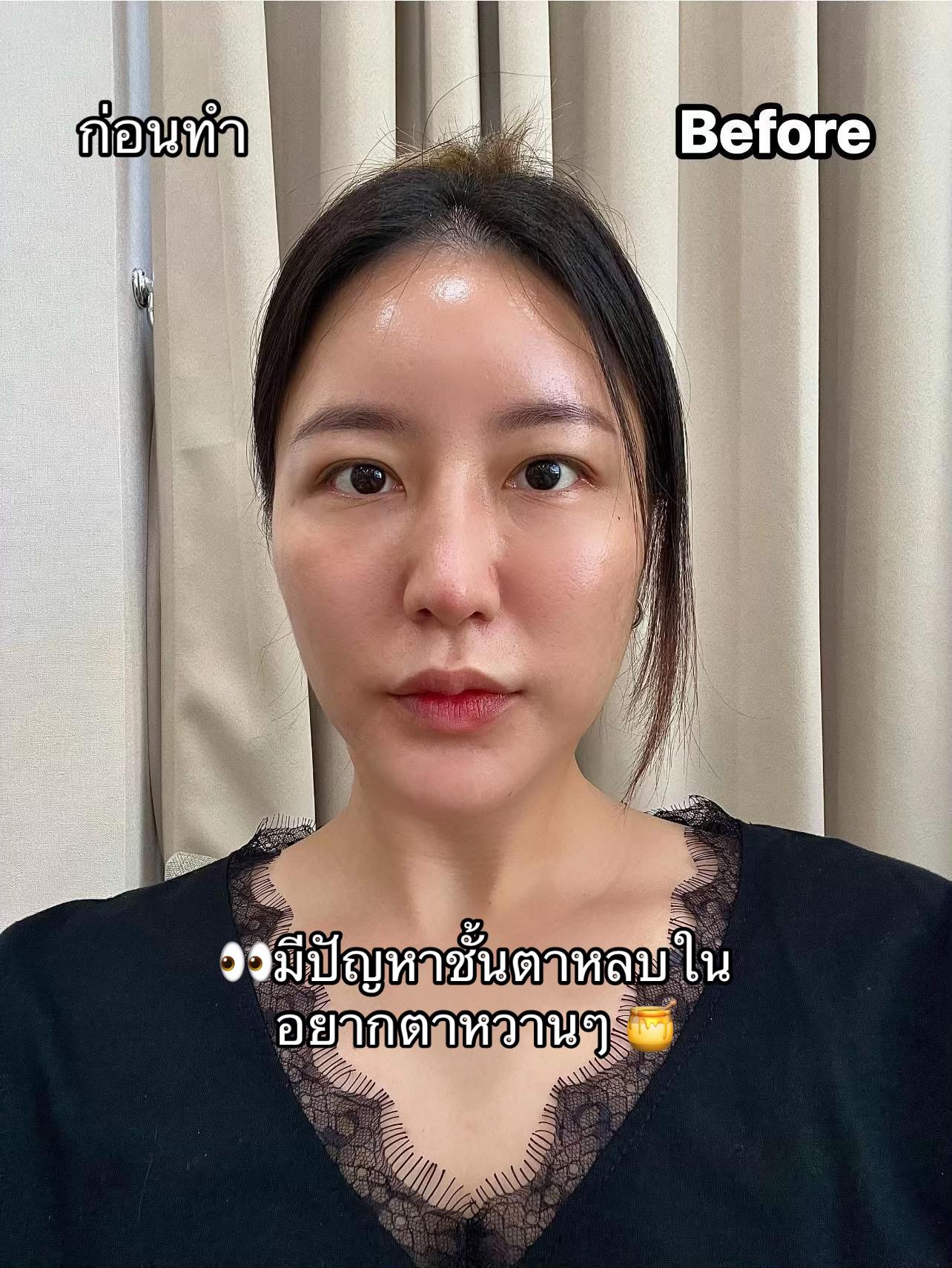 @เวลาคลินิก ตาสองชั้น ถุงใต้ตา