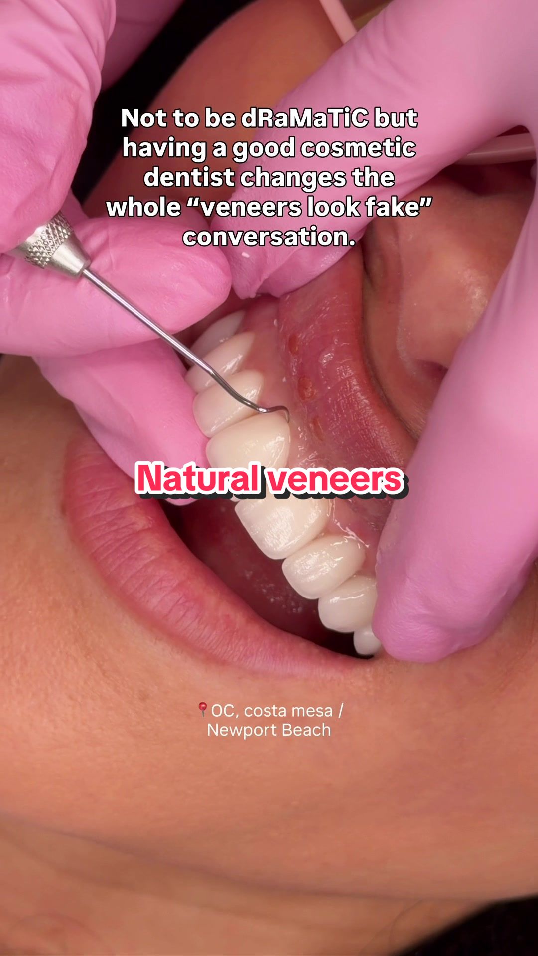 @Joycethedentist OC Veneers