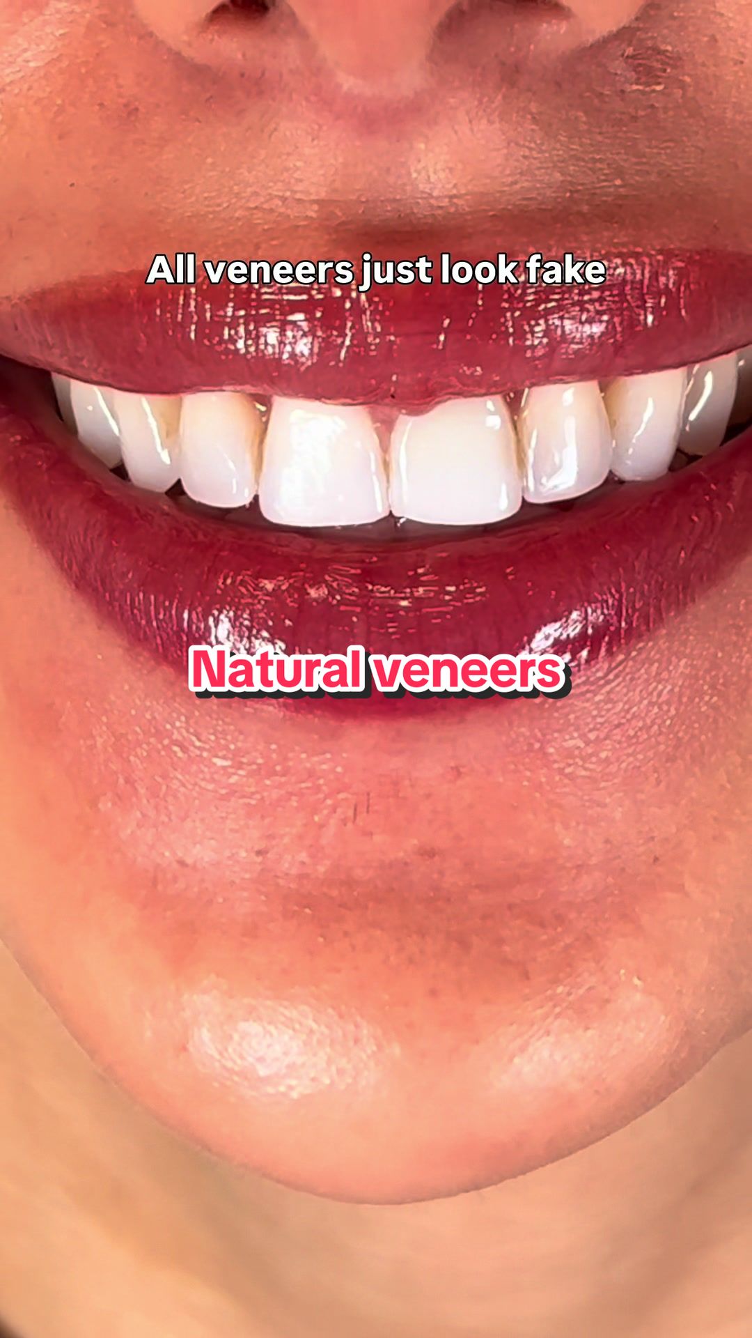 @Joycethedentist OC Veneers