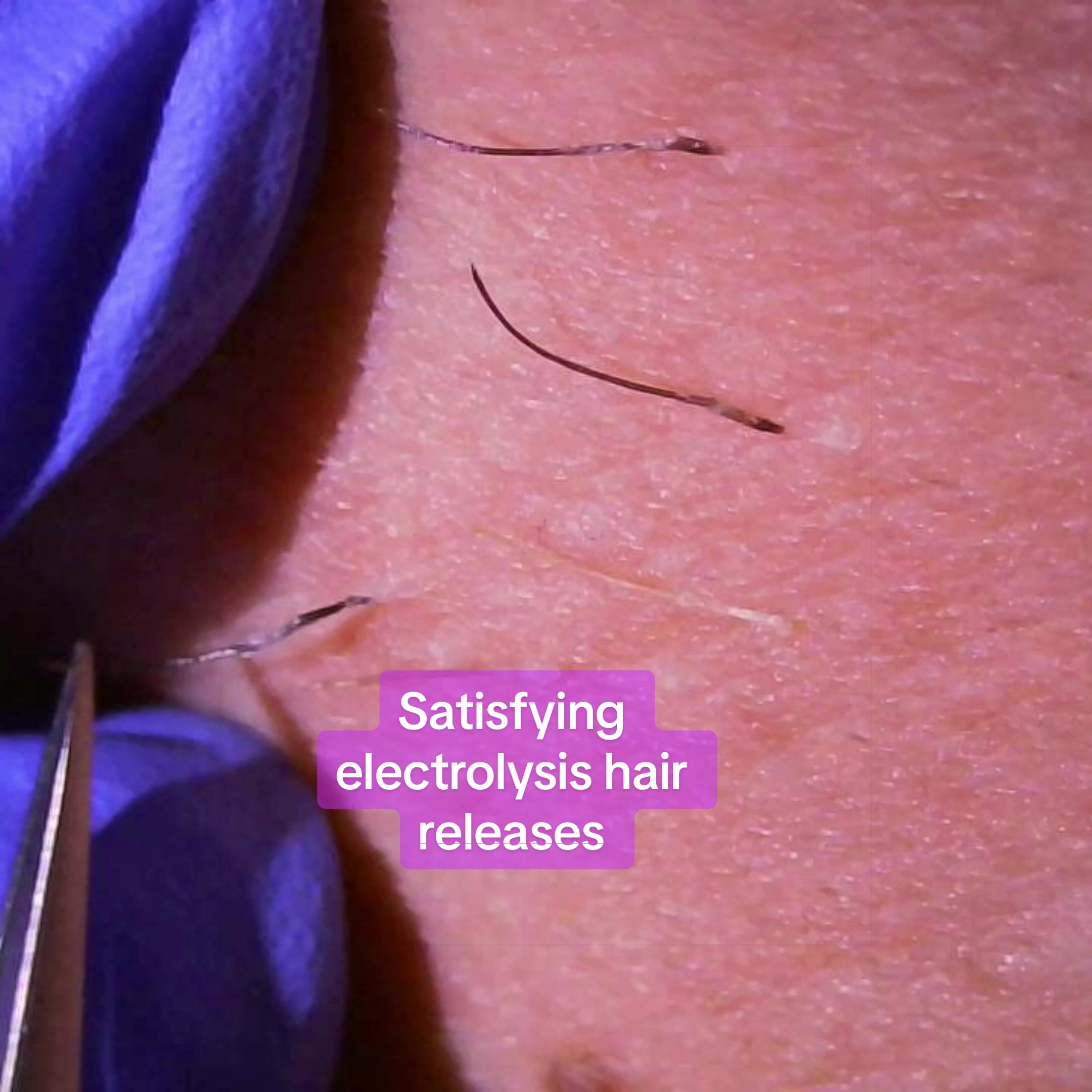 @Neurospice Beauty Electrolysis