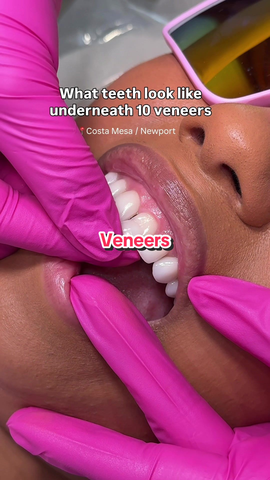 @Joycethedentist OC Veneers