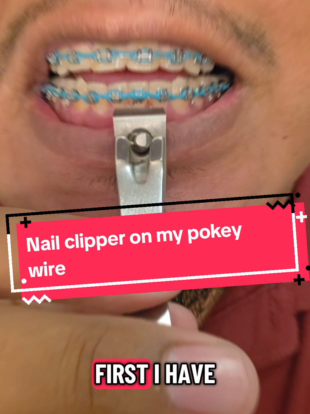 @str8braces