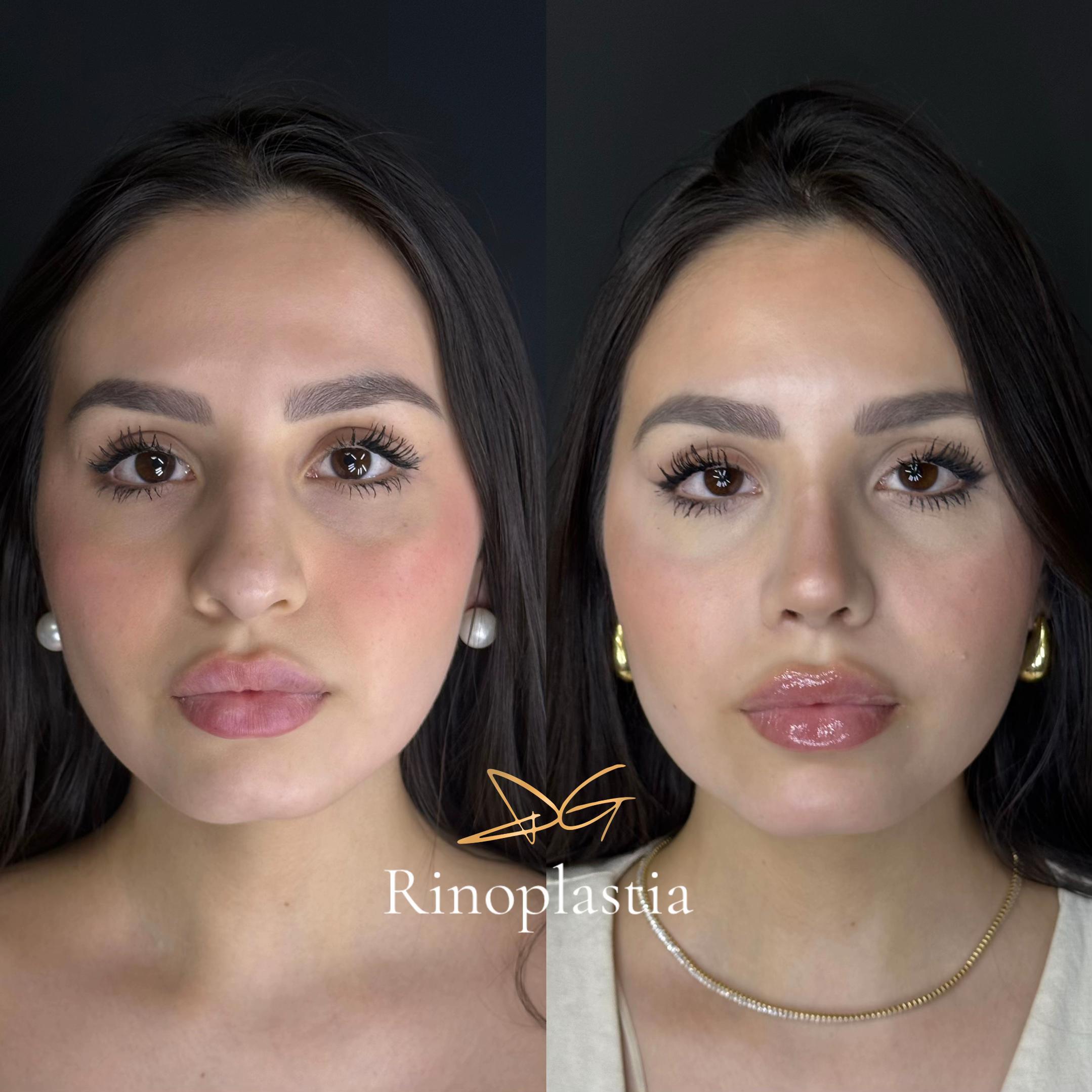 @drgarone.rinoplastia