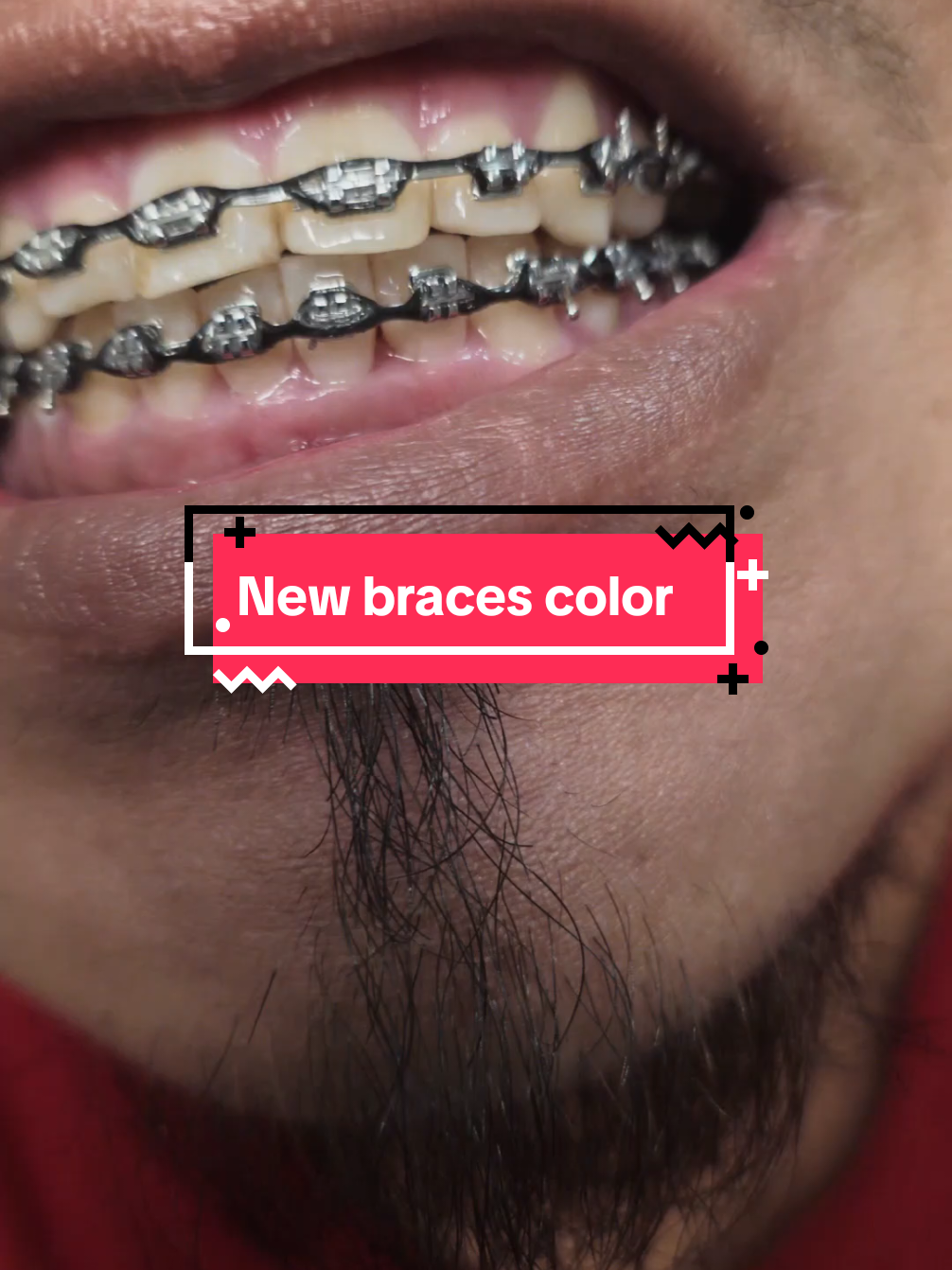 @str8braces