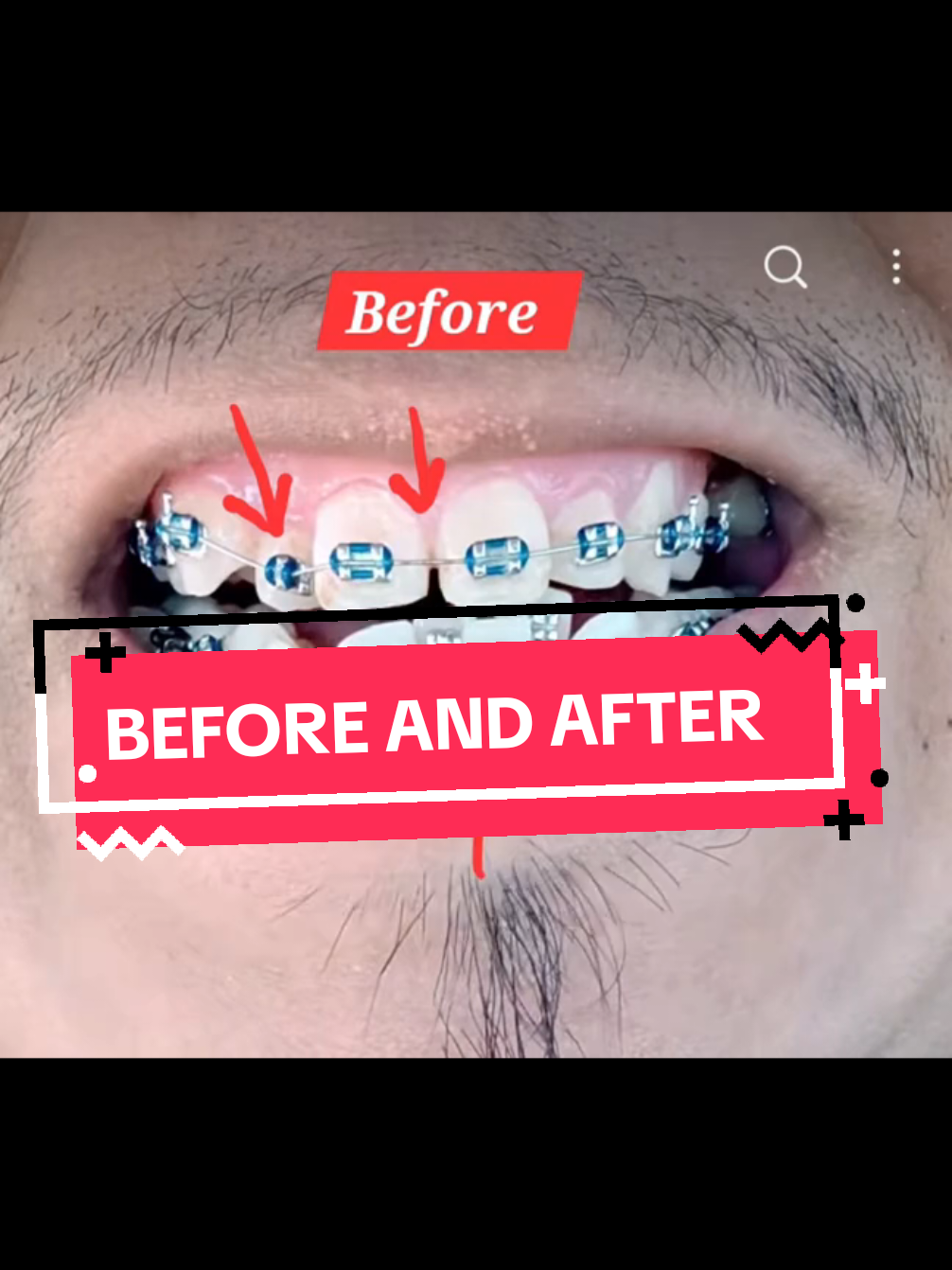 @str8braces