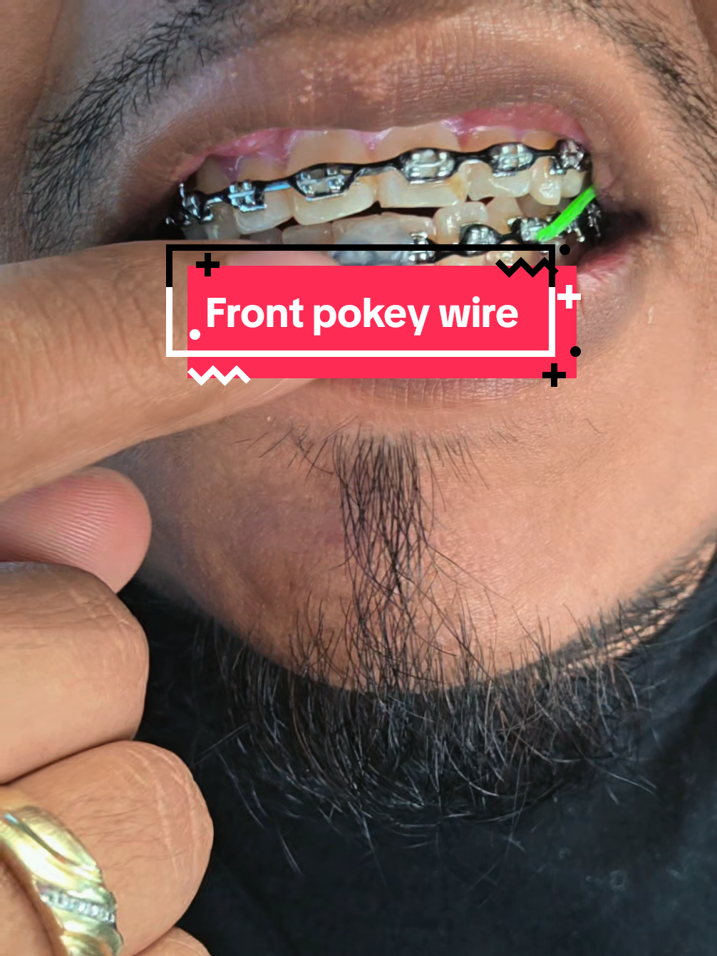 @str8braces