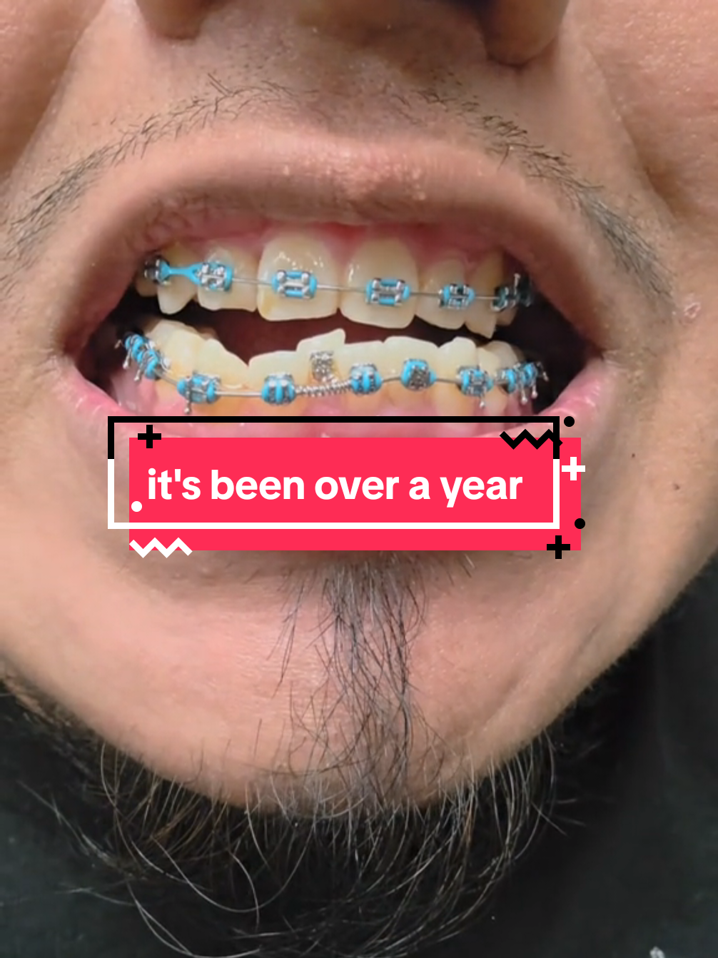 @str8braces