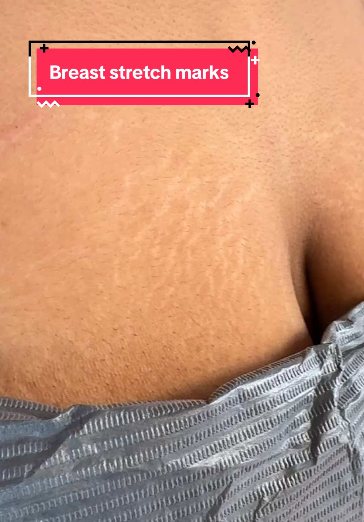 @Invisibleskinhelp