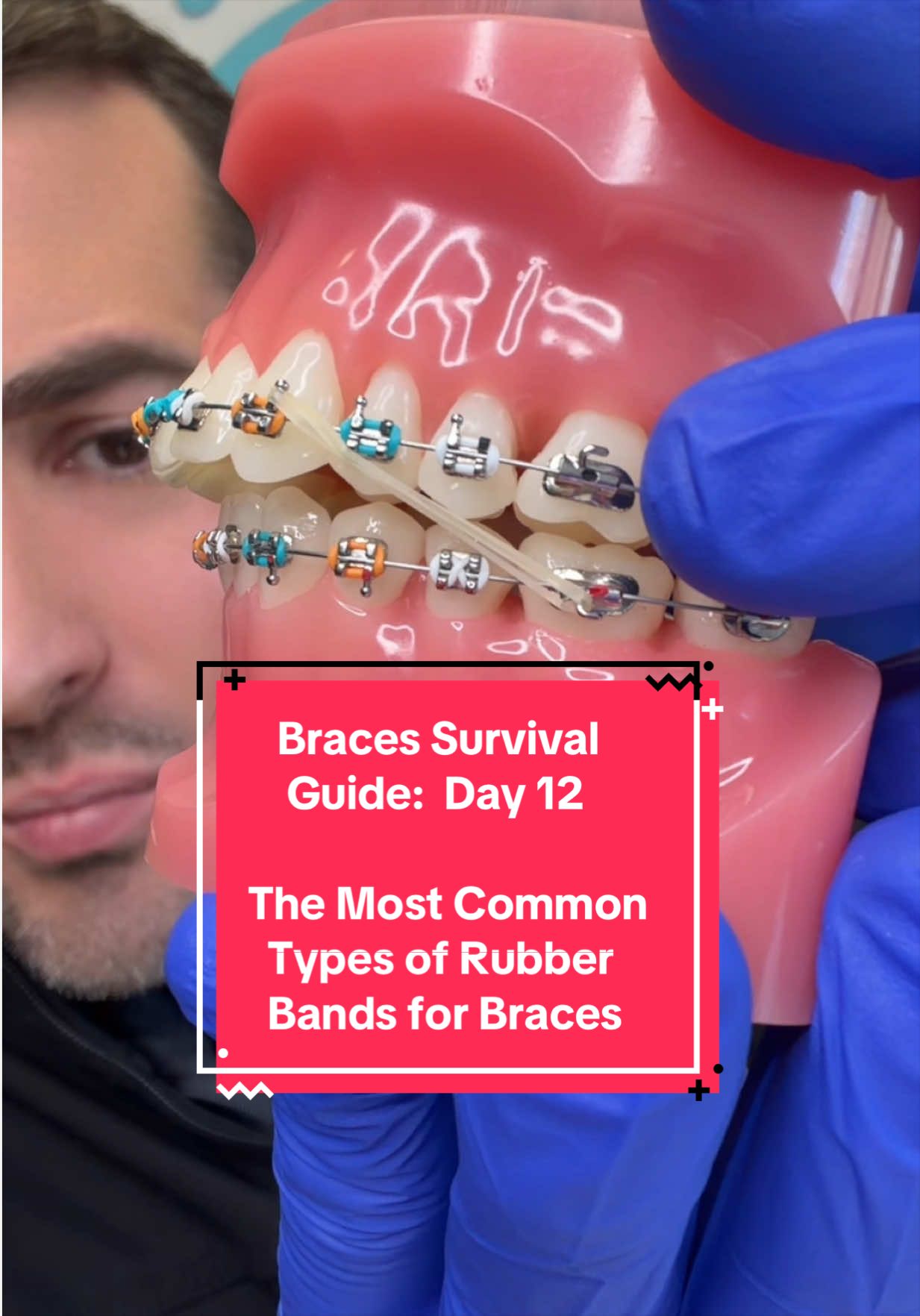 @Braces Survival Guide