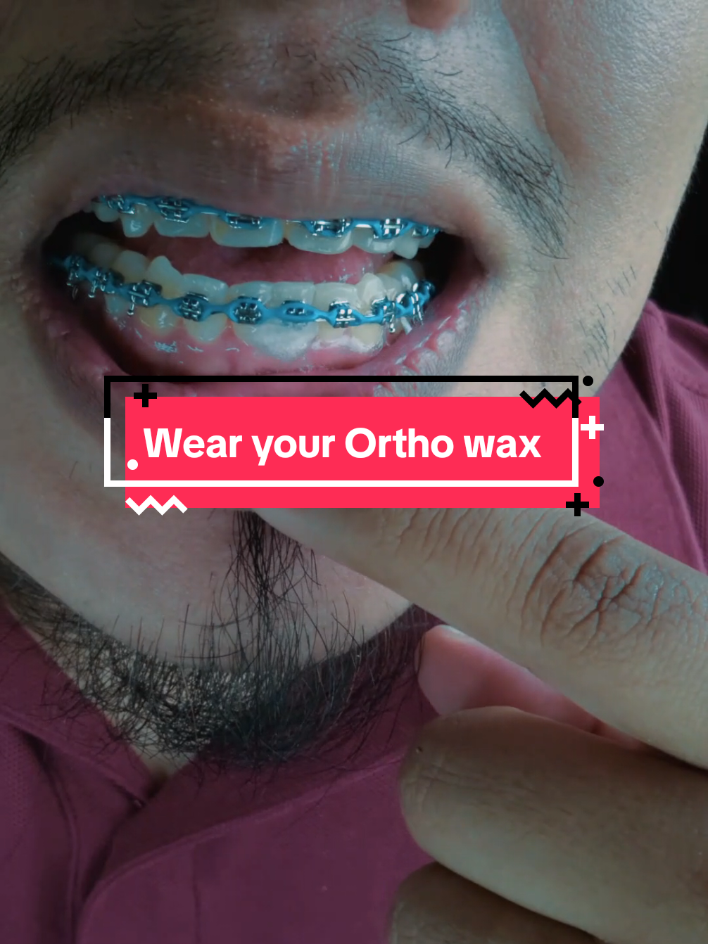 @str8braces