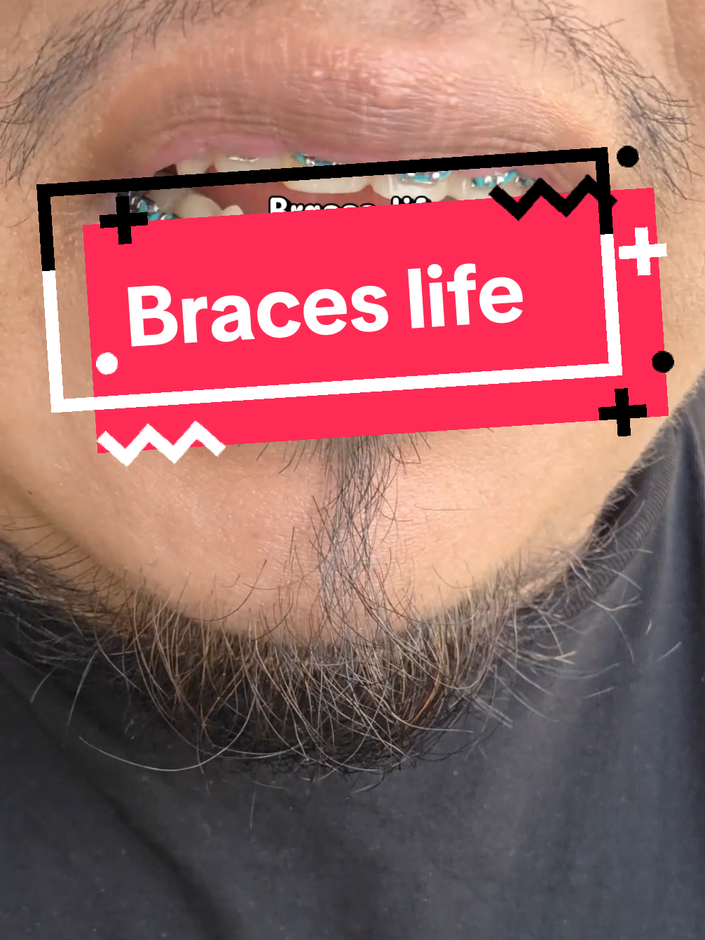 @str8braces