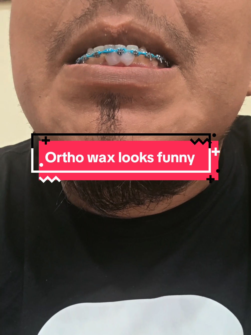 @str8braces
