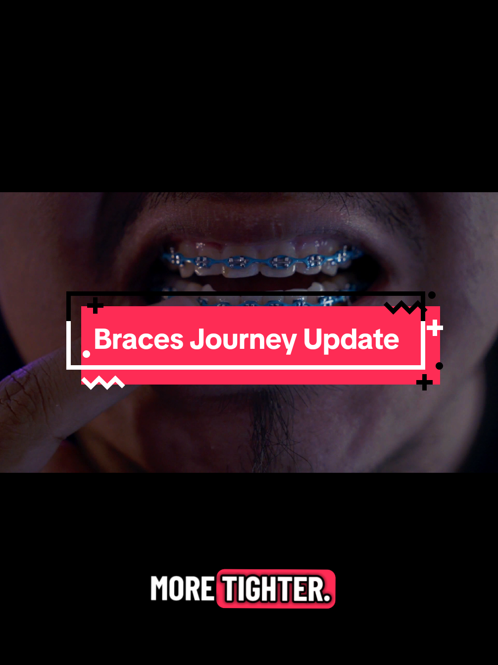 @str8braces