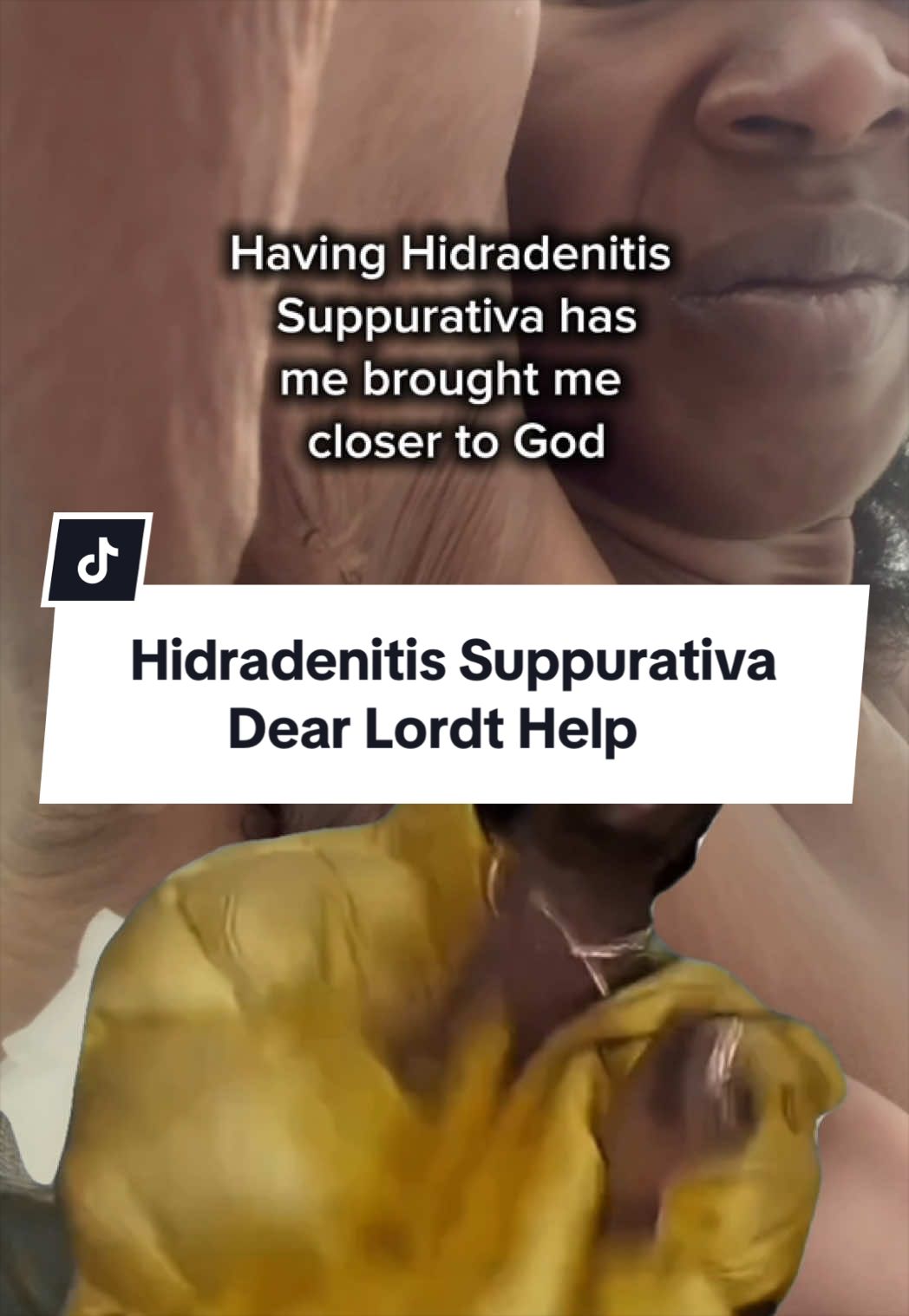 @Hidradenitis & Relief