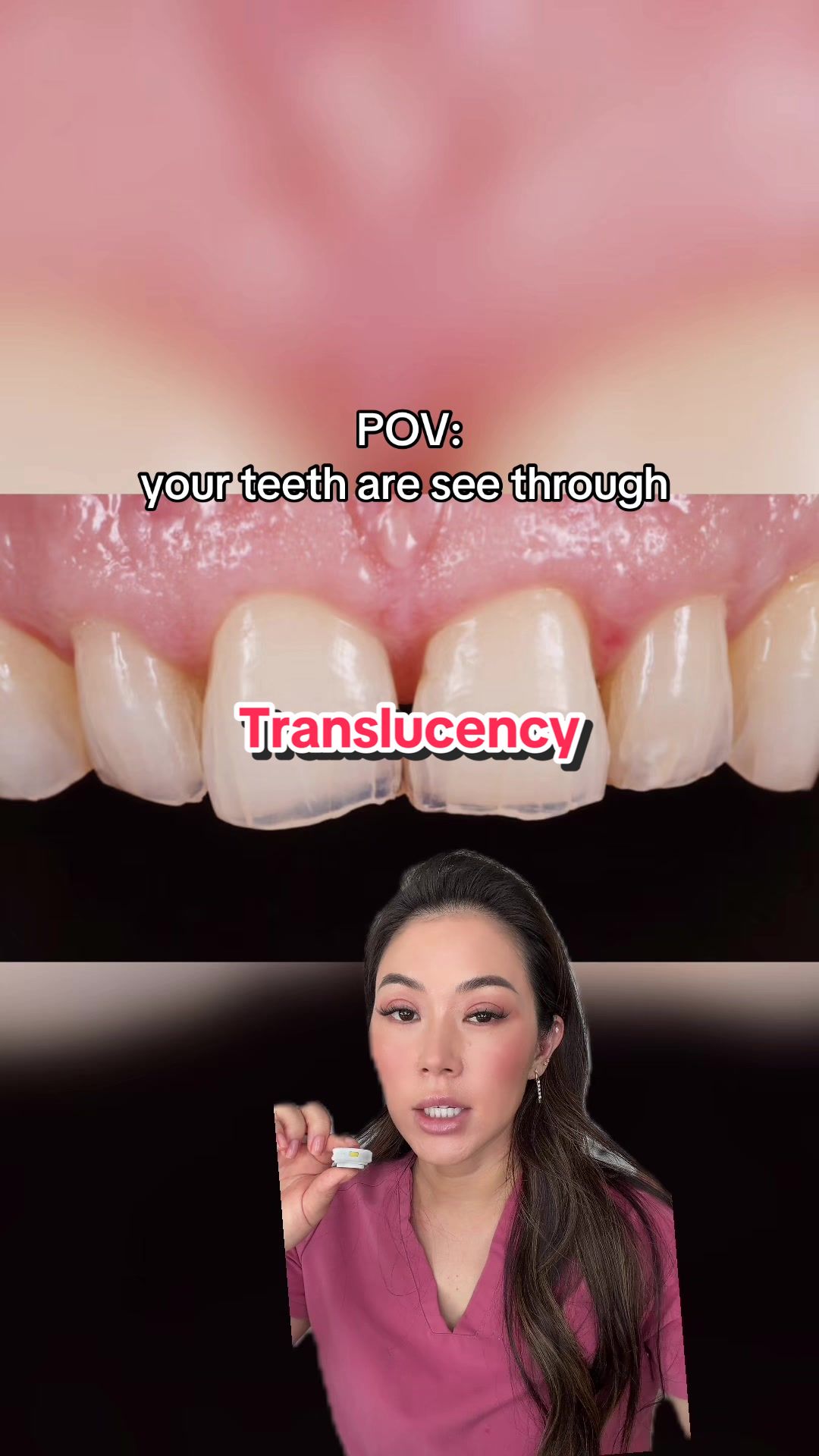 @Joycethedentist OC Veneers