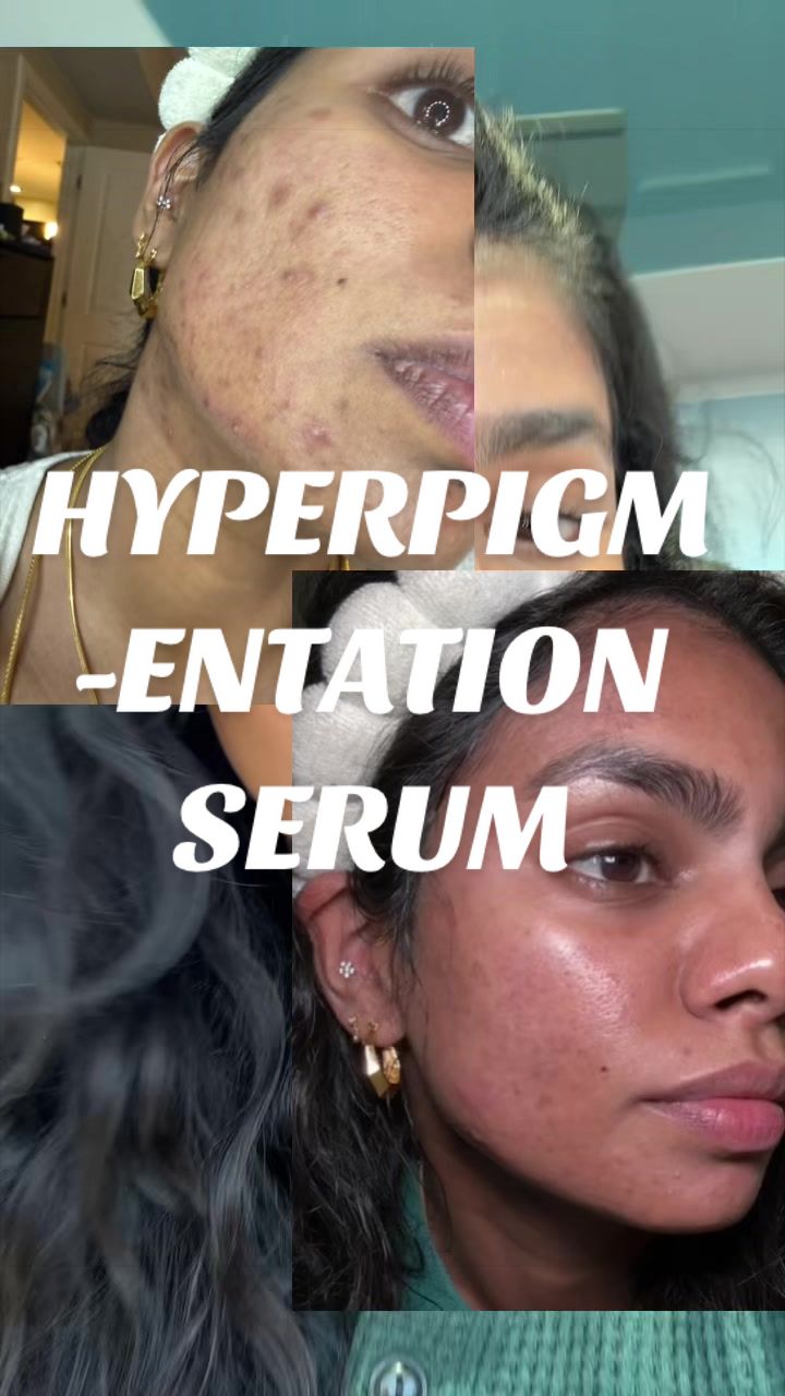 @Nyx Curations | Acne +Wellness