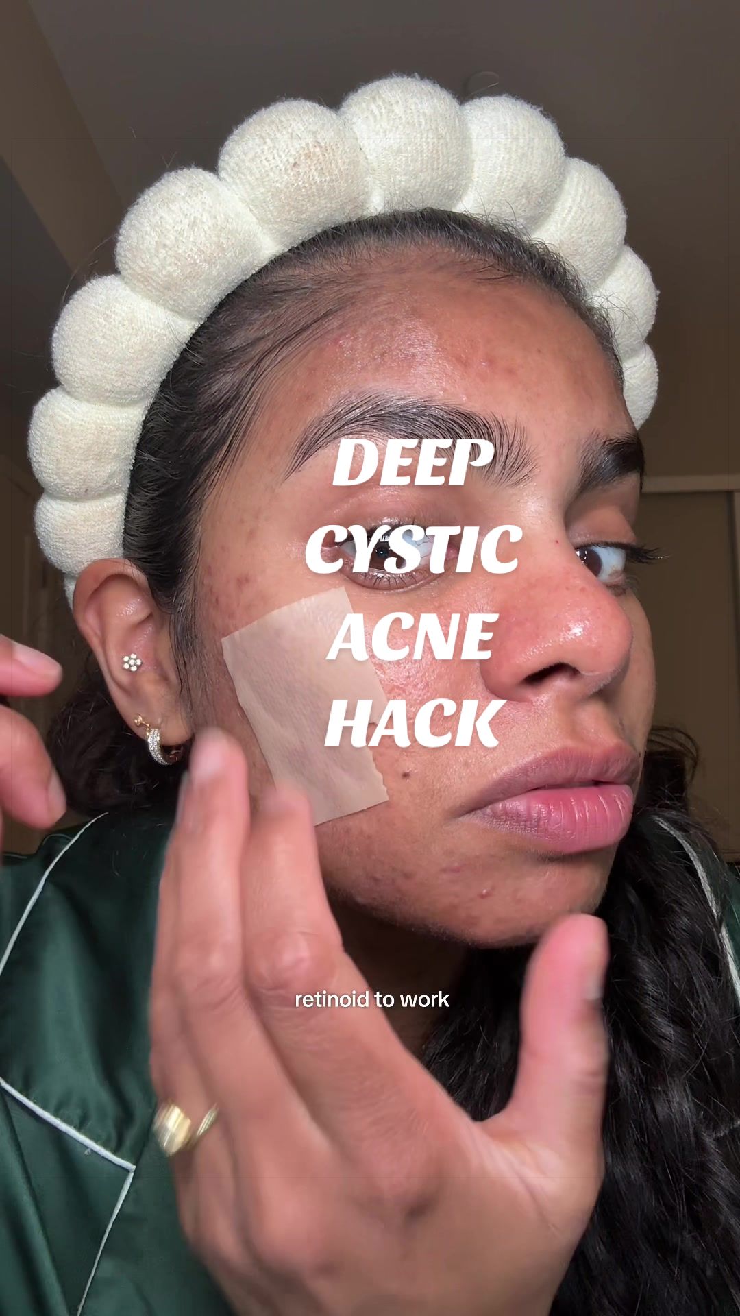@Nyx Curations | Acne +Wellness
