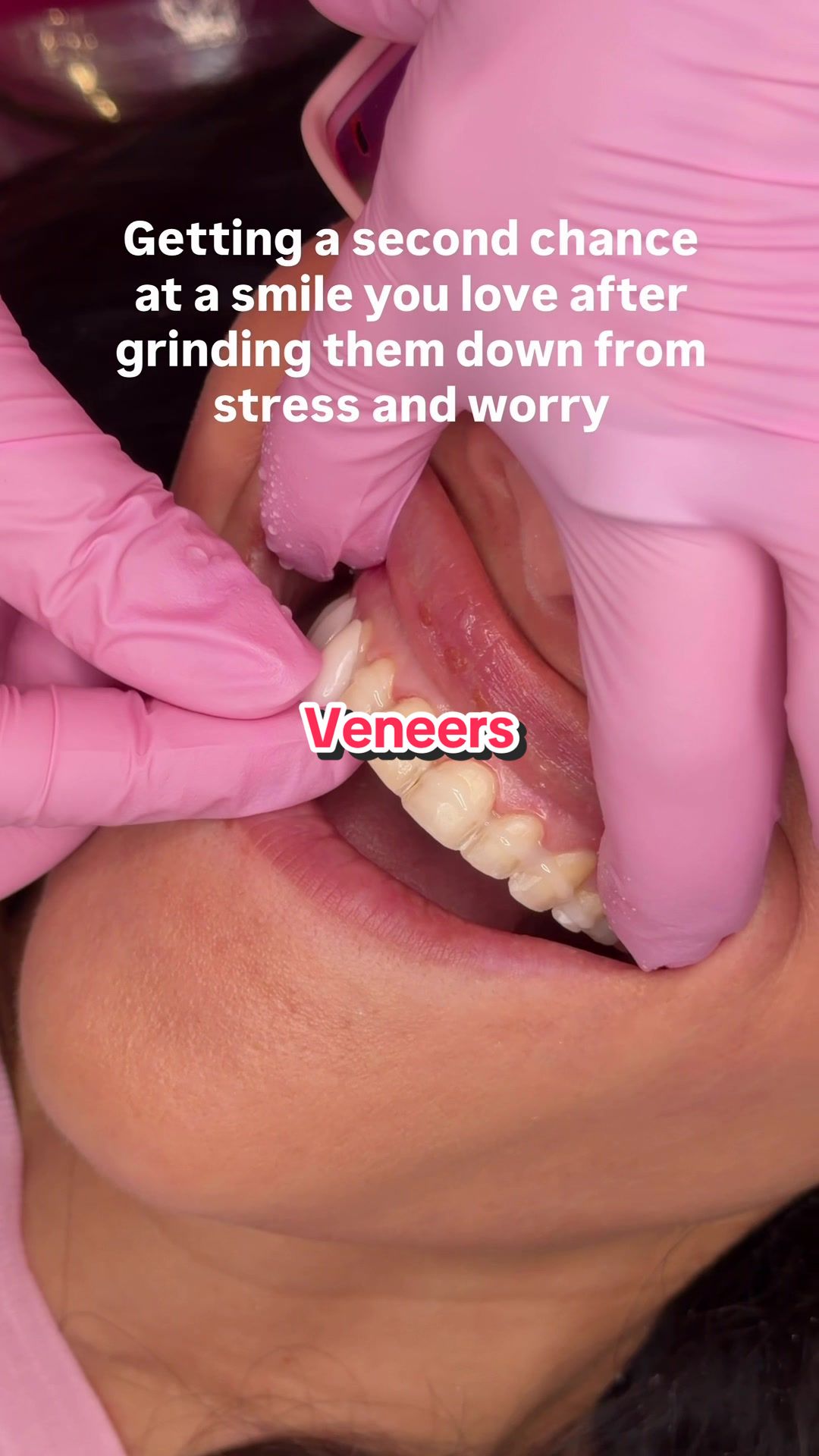 @Joycethedentist OC Veneers