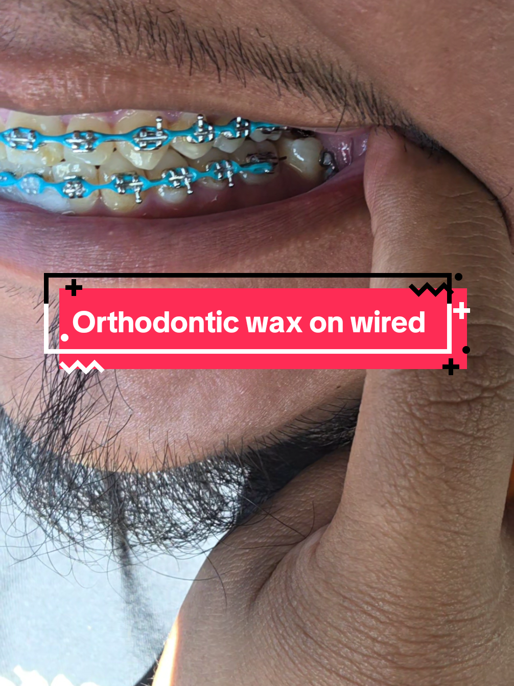 @str8braces