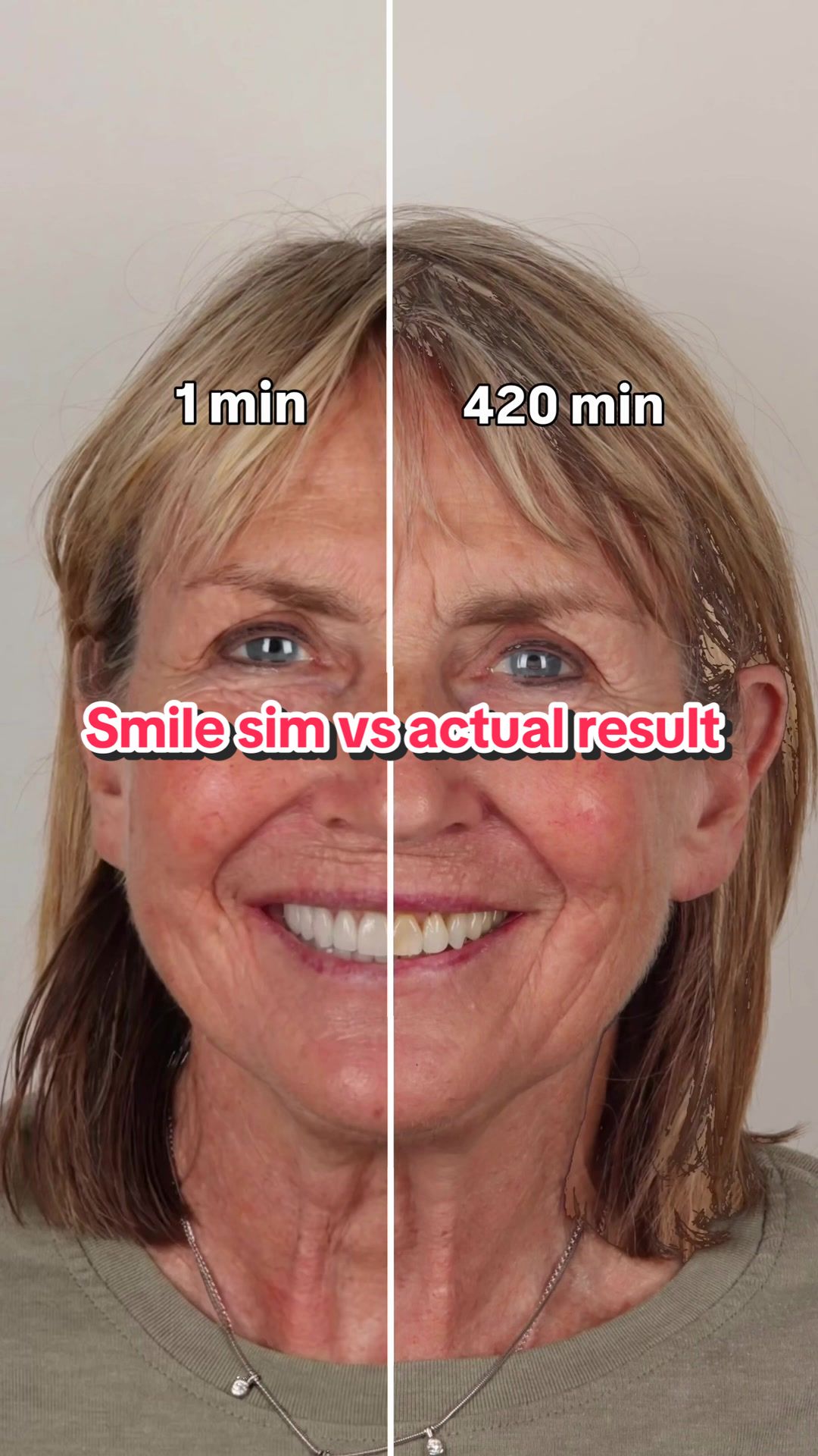 @Joycethedentist OC Veneers